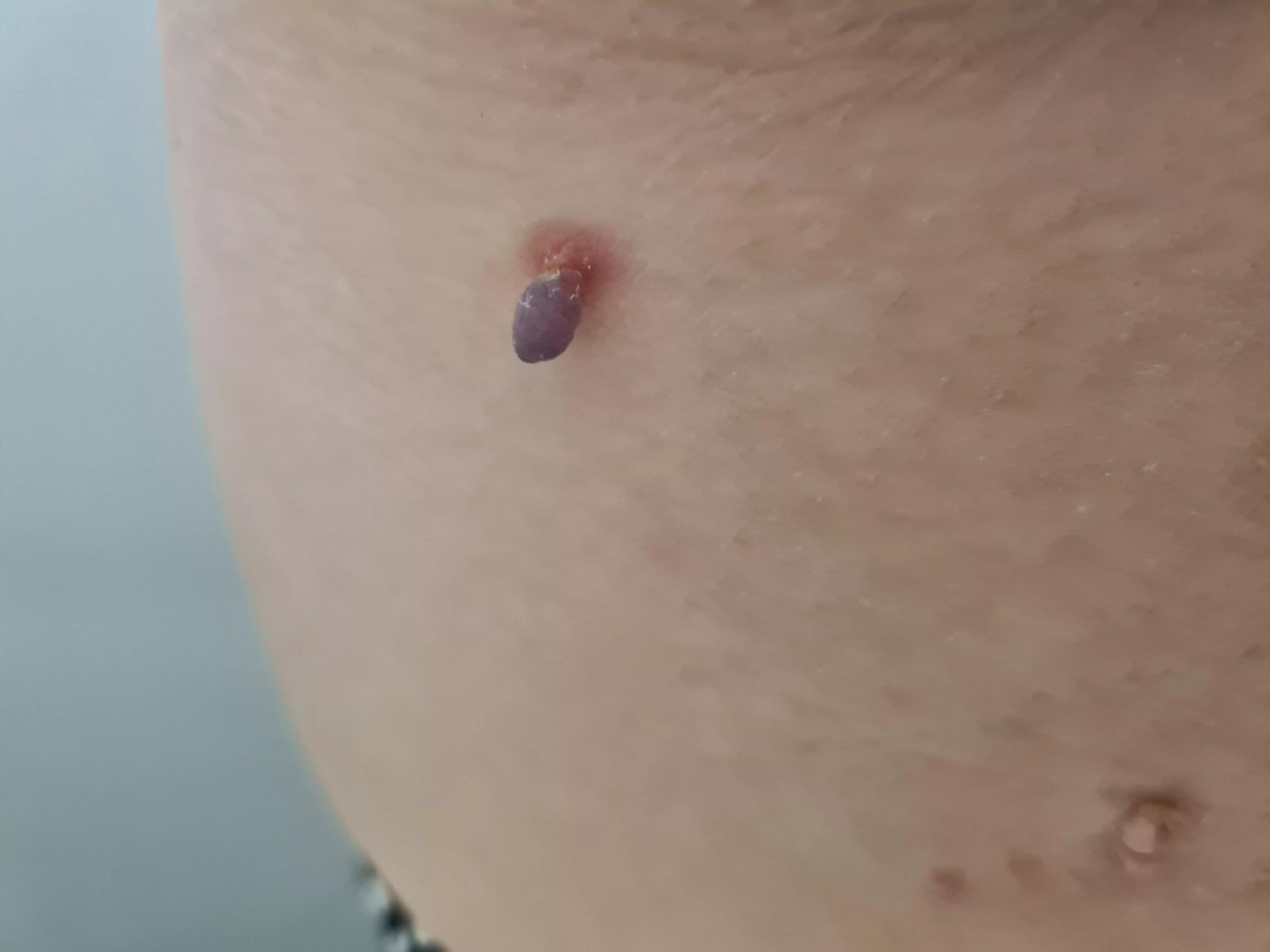 I sometimes get little skin tags where my bra sits. Never one like this, though! Getting it cauterised tomorrow as it's extremely painful. posted by lady-of-everything