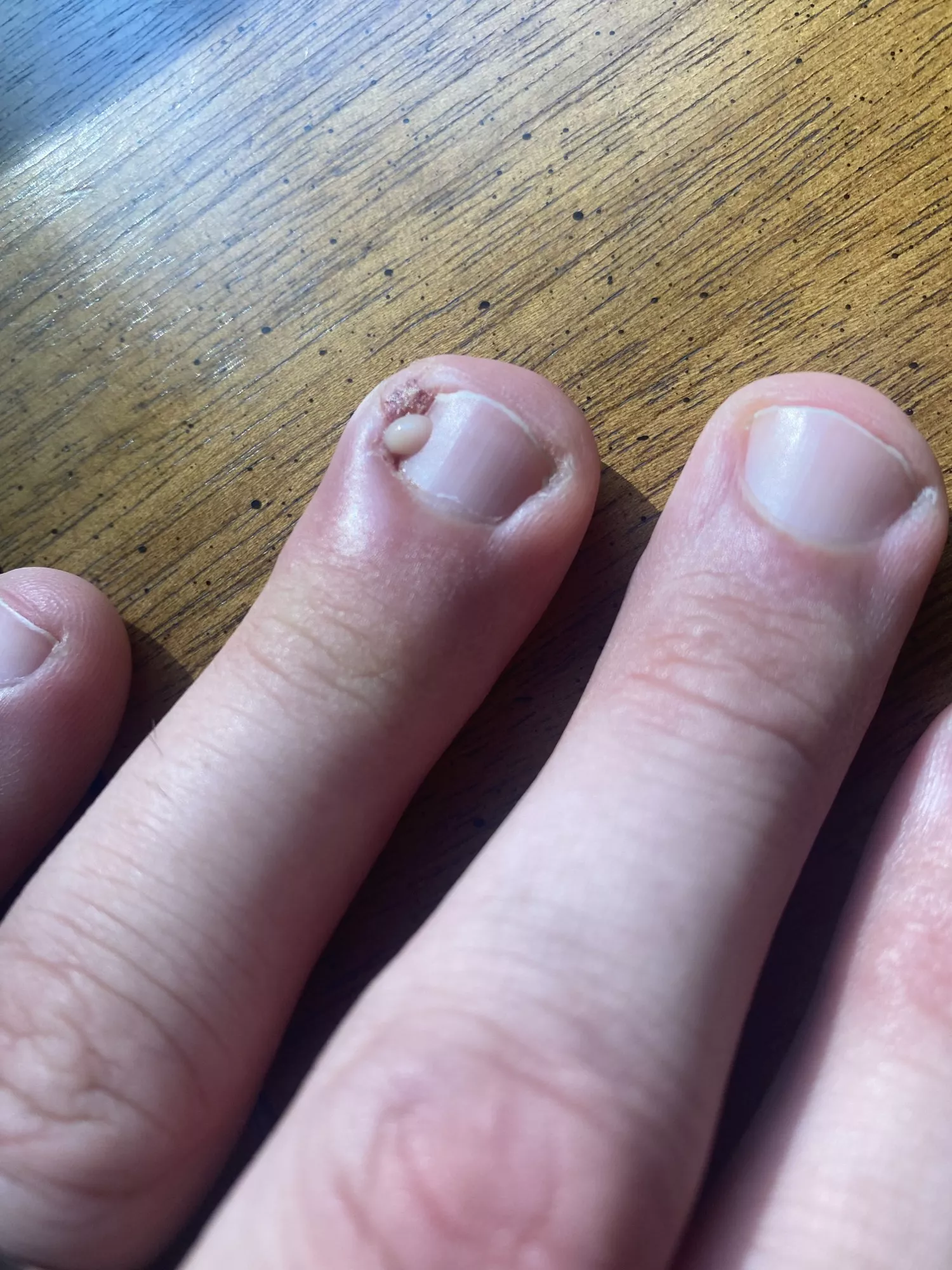 Ingrown fingernail. Hurts so bad I was shaking. posted by detzelpretzel