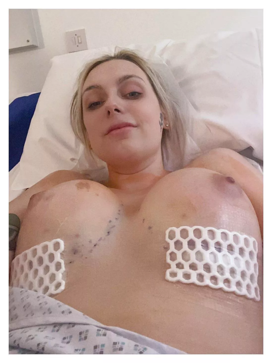 Just otu of surgrey! Still super sore and achey, but everything went well and m happy/healthy. Went from 34B to a 34E posted by nonstopopen