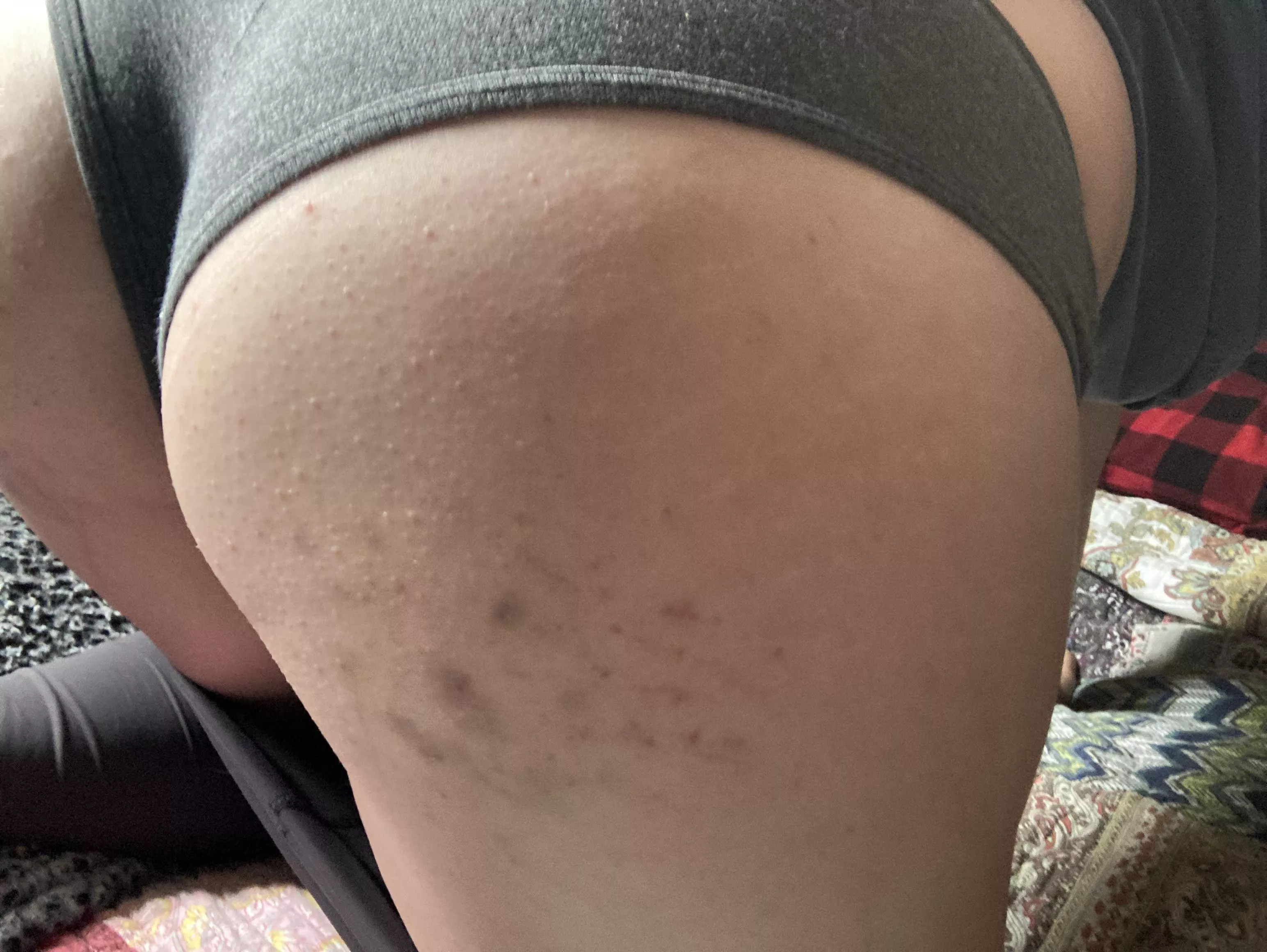 Light bruising from my first spanking session posted by harley420_