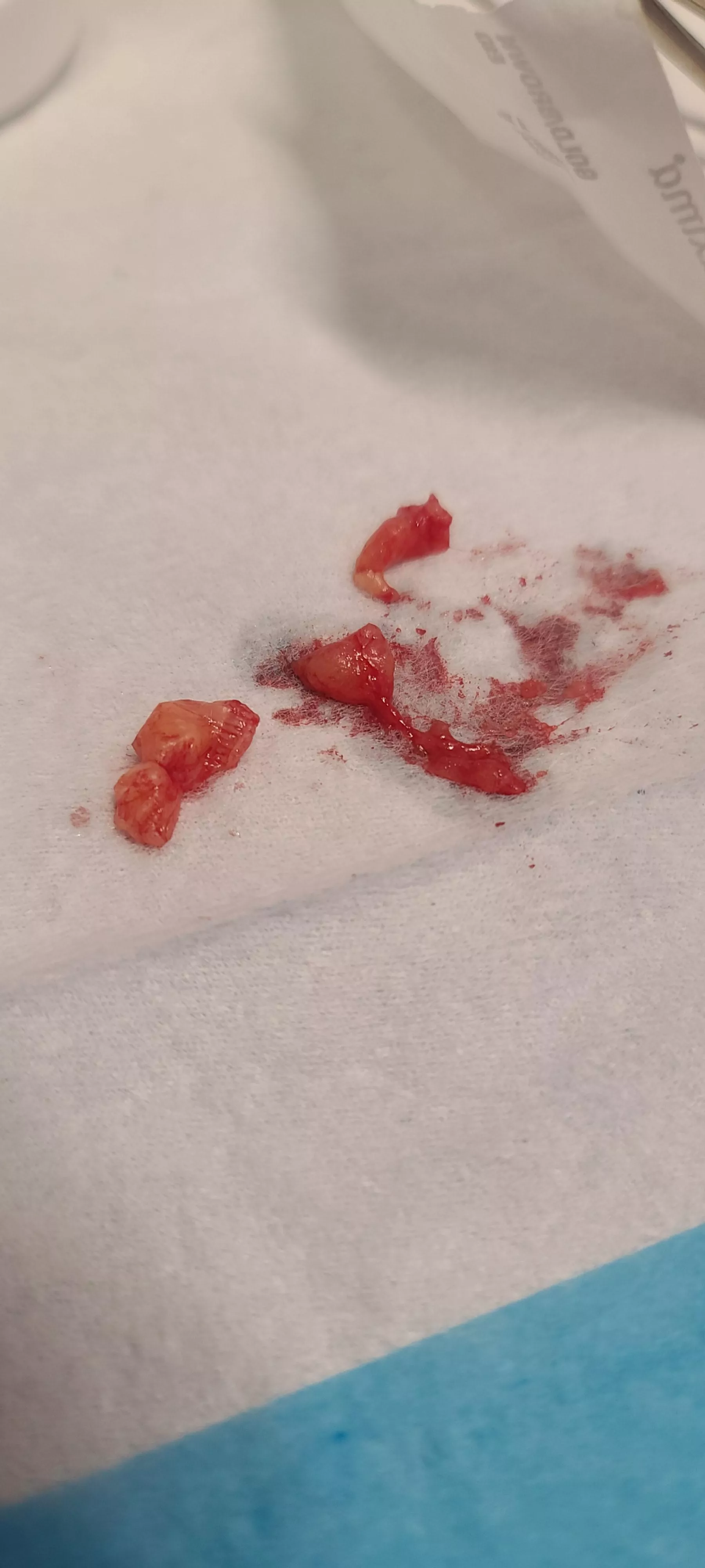 Lipoma removed from groin posted by krazy_chick195