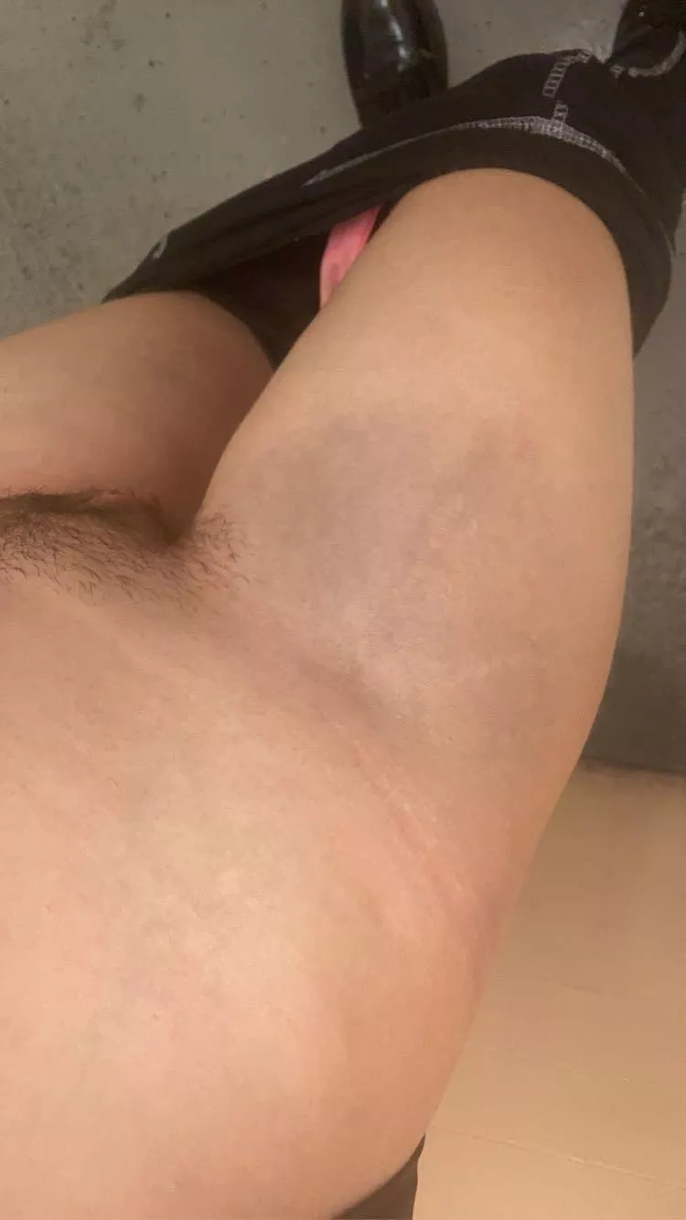 look at my bruised thigh🥲 posted by raineThetopic