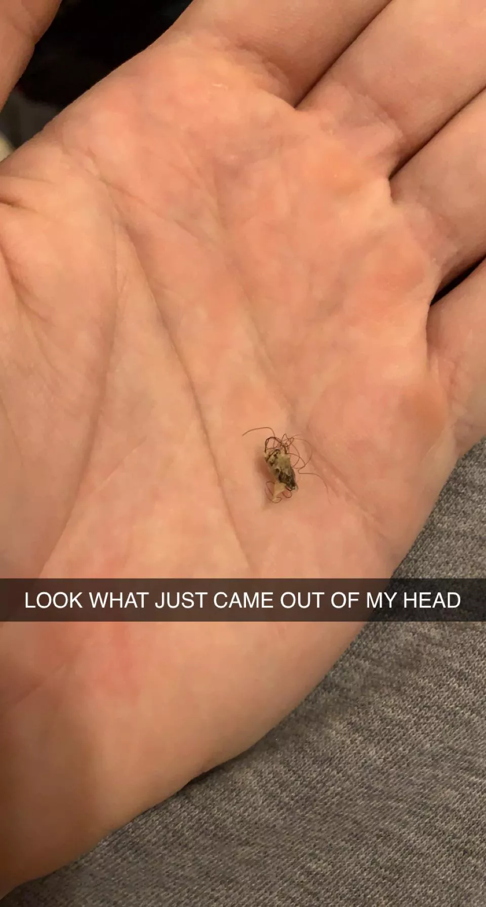 Look at the ingrown my GF just pulled out of the back of my head. I can feel a dip where it used to be posted by doomplayer413