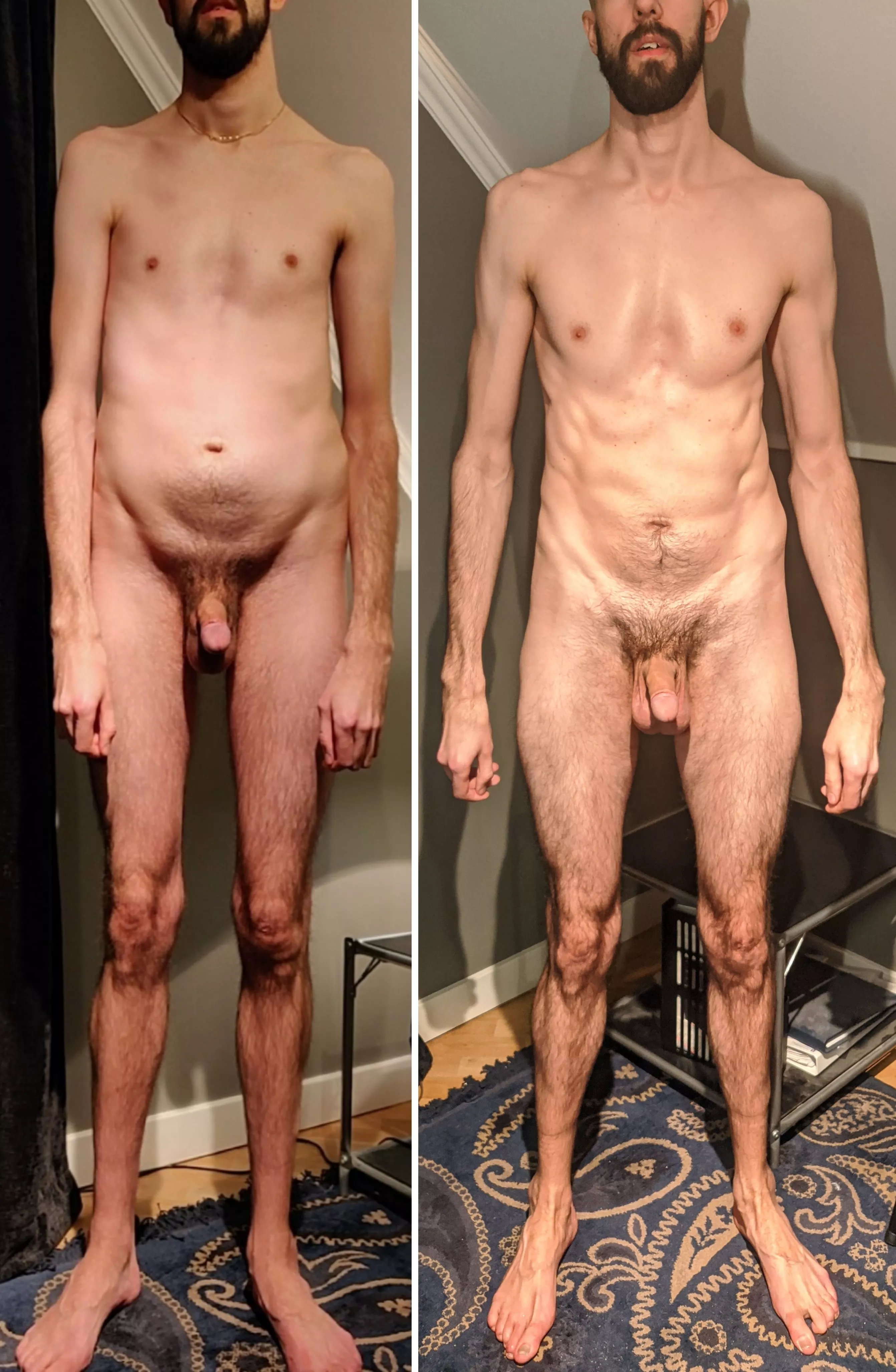 [M]arfan's Syndrome. 30y, 159lbs, 6'6