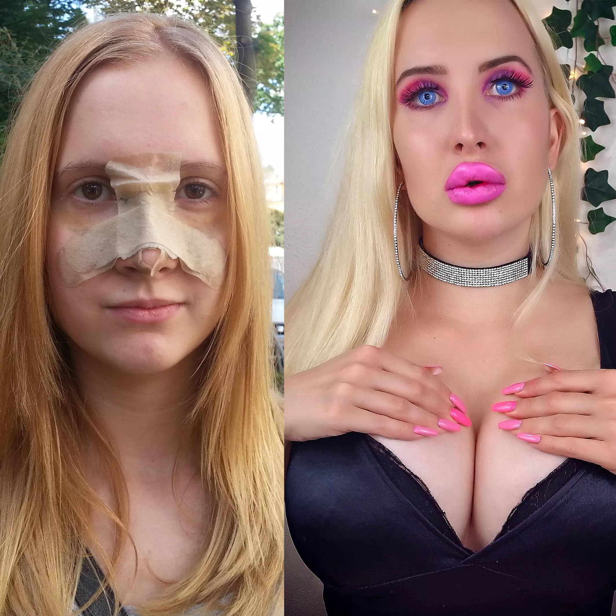 Me after getting my nose job vs now 💗 More fillers on 16th Nov. - The journey continues 🥰 posted by Vivian_Rose1