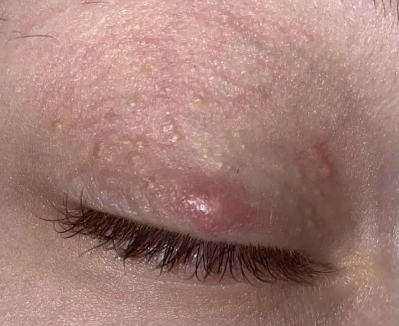 Milia Infected? I stupidly tried popping it. What to do? It's been 3 days of being swollen. I've tried teabags, warm compresses. I've had them for years. posted by ddodiee