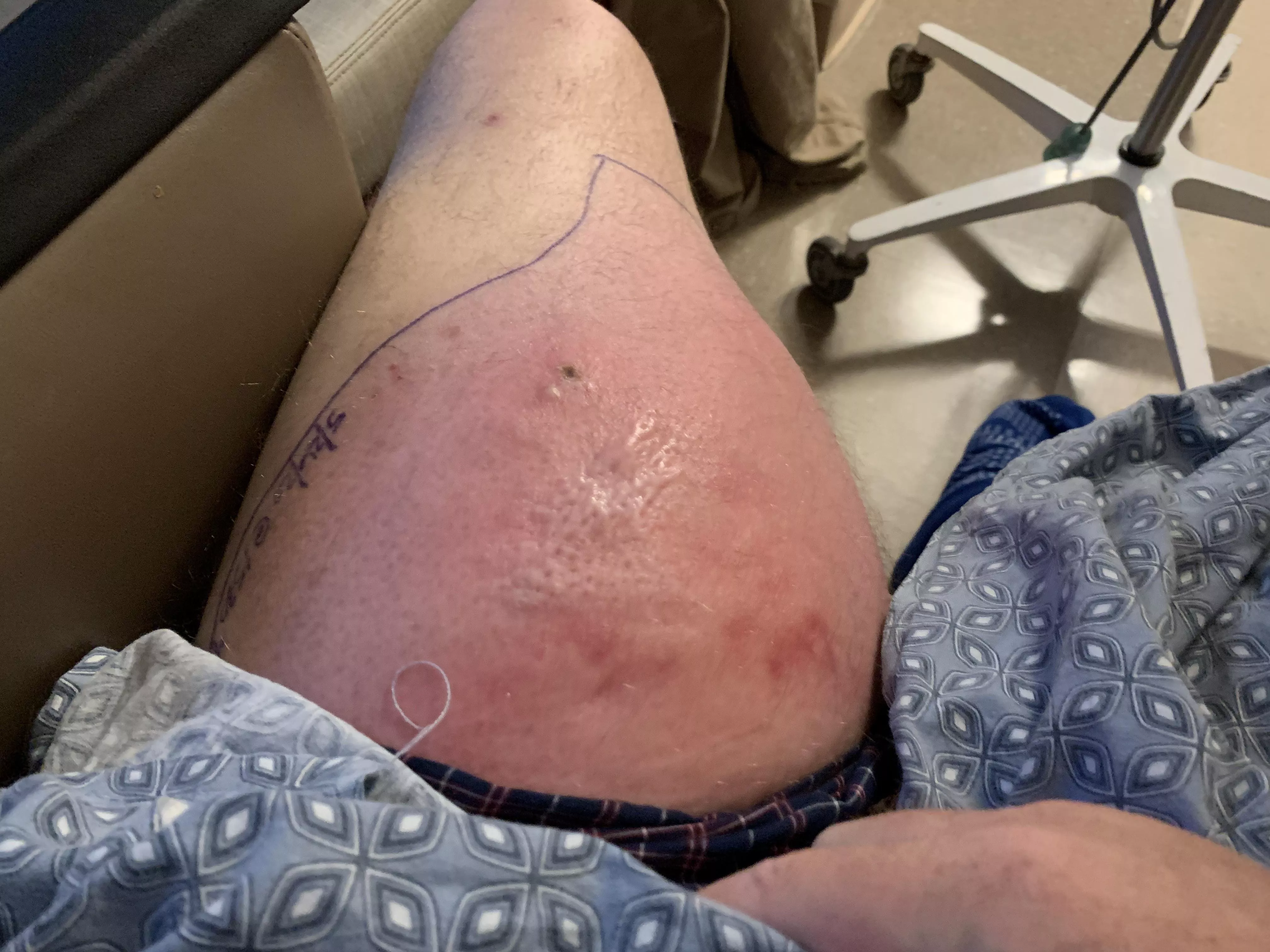 MRSA, spent a week in the hospital on IV antibiotics for this infection. If I stood it would drain on its own. Gave him a squeeze and a long black string came out. Surgeon, told me it was a vein. Had to pack it for two weeks after. posted by BigOleBlueEyesBaldy