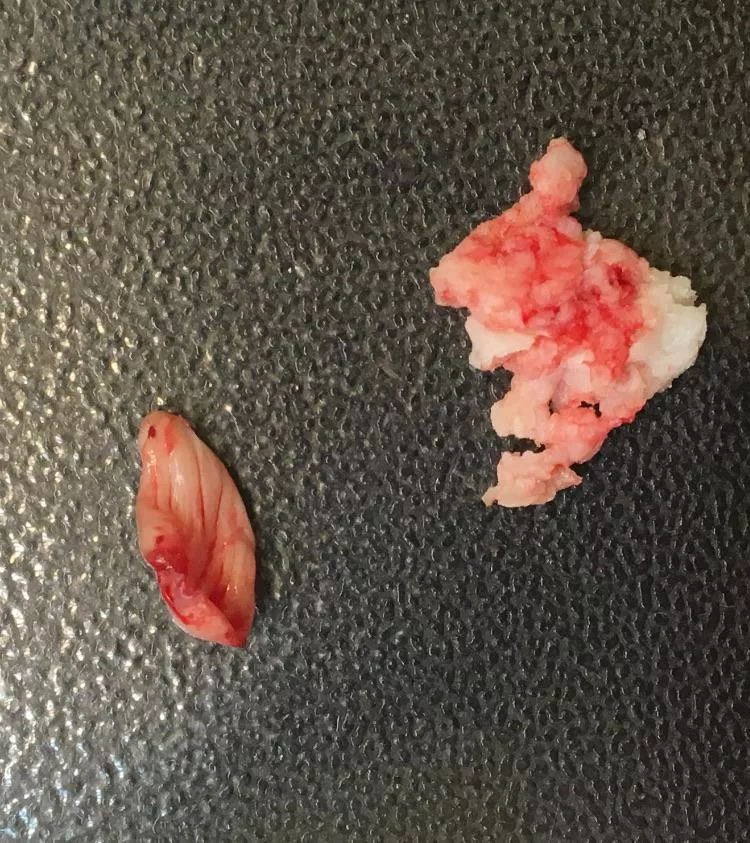 My cyst burst and I made my boyfriend pull the sac out of my shoulder while he was on LSD. He is NOT a popping fan! posted by jess0729ex