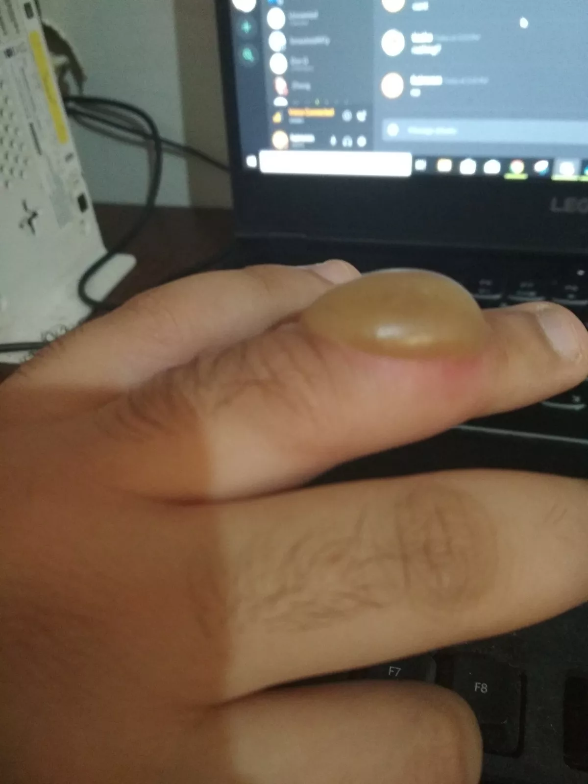 My finger after touching boiled oil then a glass of ice immediately after posted by Eight111