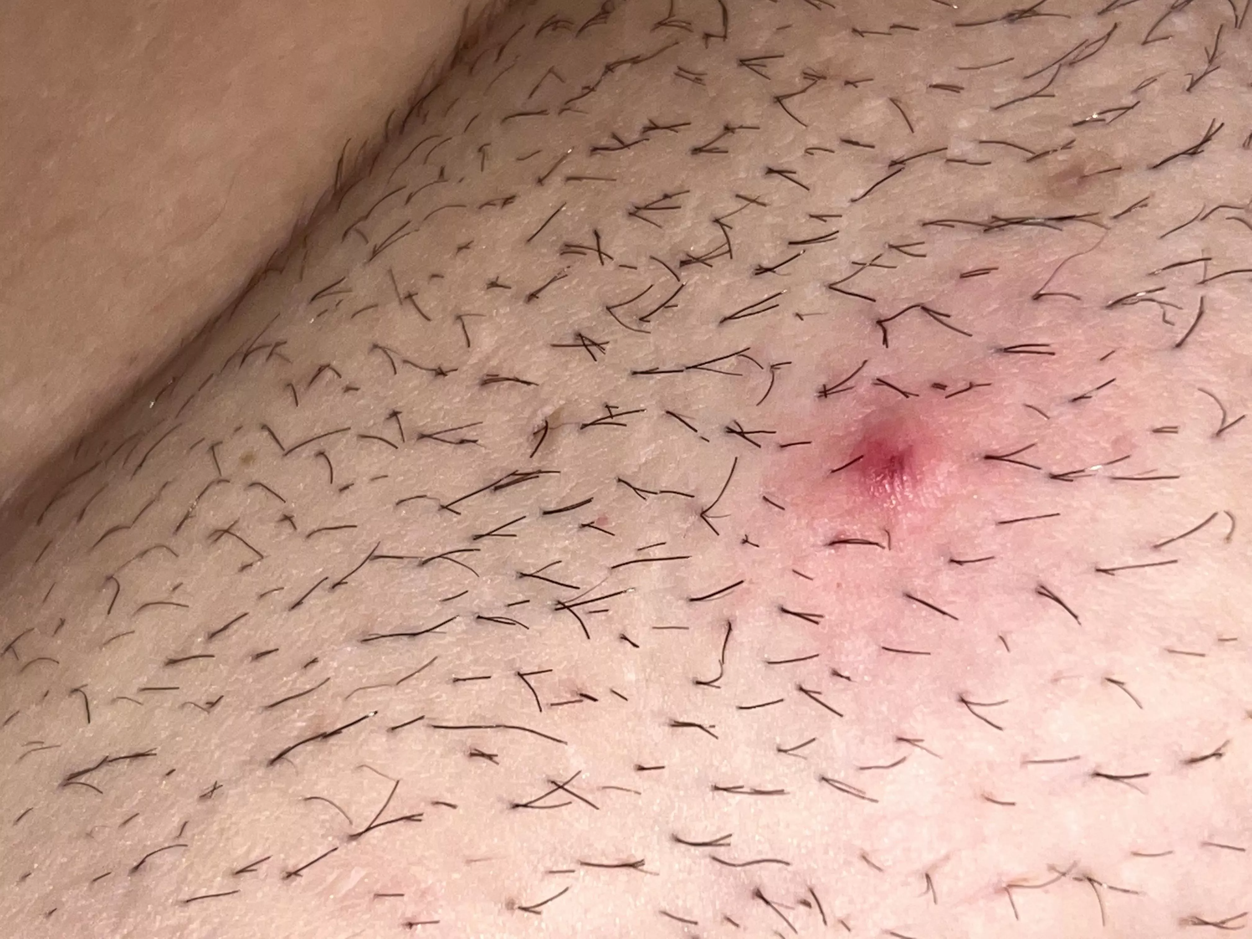 My pubes suck! So many double or triple hairs causing ingrowns! NSFW because beaver. posted by Kimbobrains