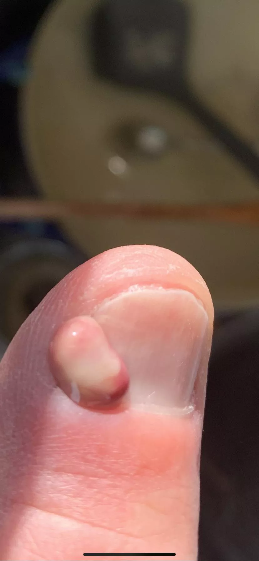 My thumb throbbed for a good 24 hours before I was able to let er rip posted by Partythyme00