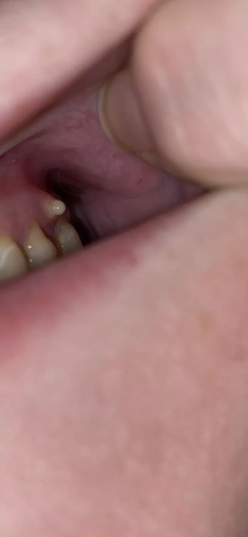 Nasty gum infection photo popped right after this was taken posted by Vaguedplague