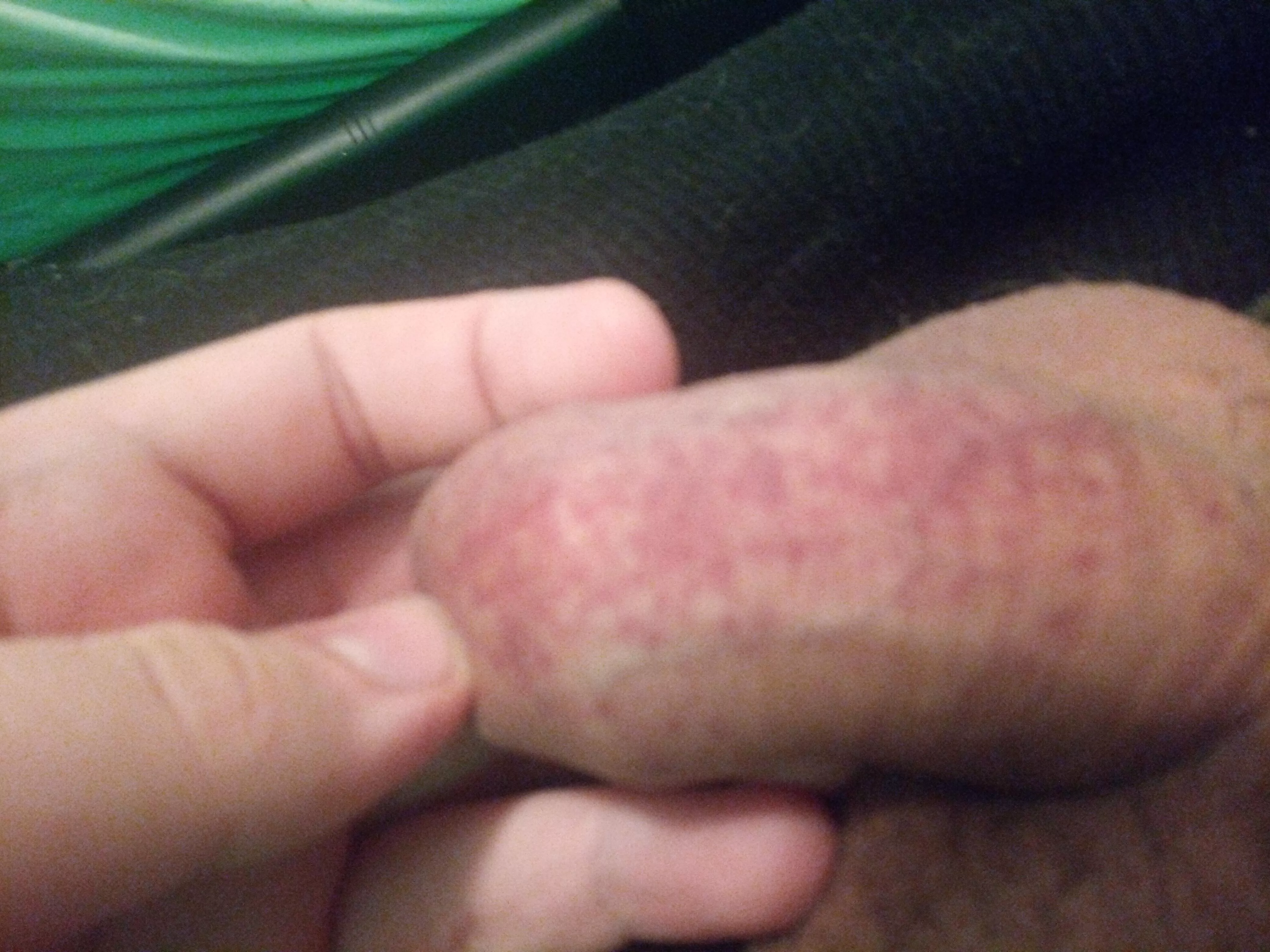 New to pumping and need help (petechiae appears after every time a try cock pumping ) posted by No_Afternoon_4506