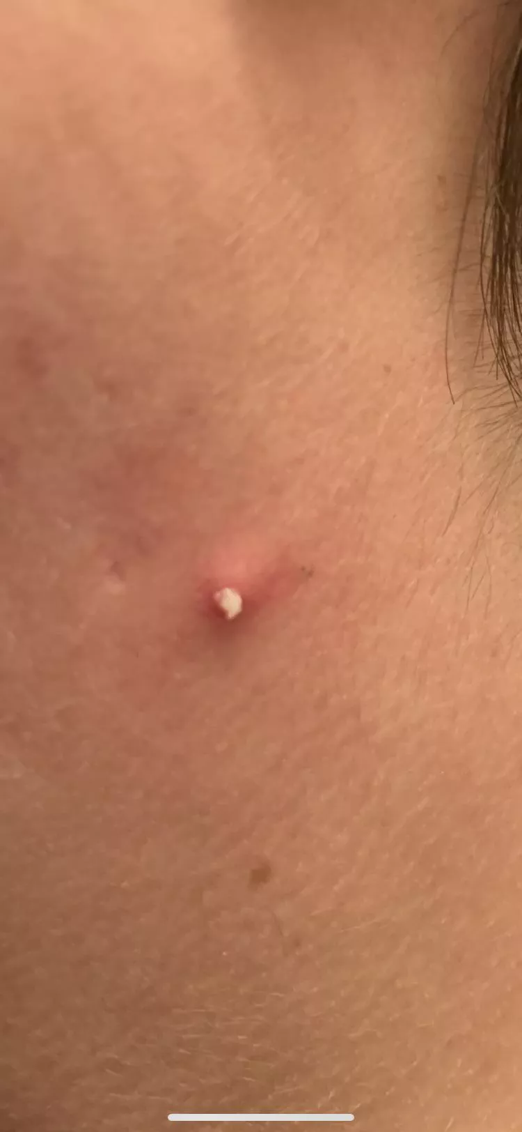 Nice pop on my neck this morning posted by iusestolivein