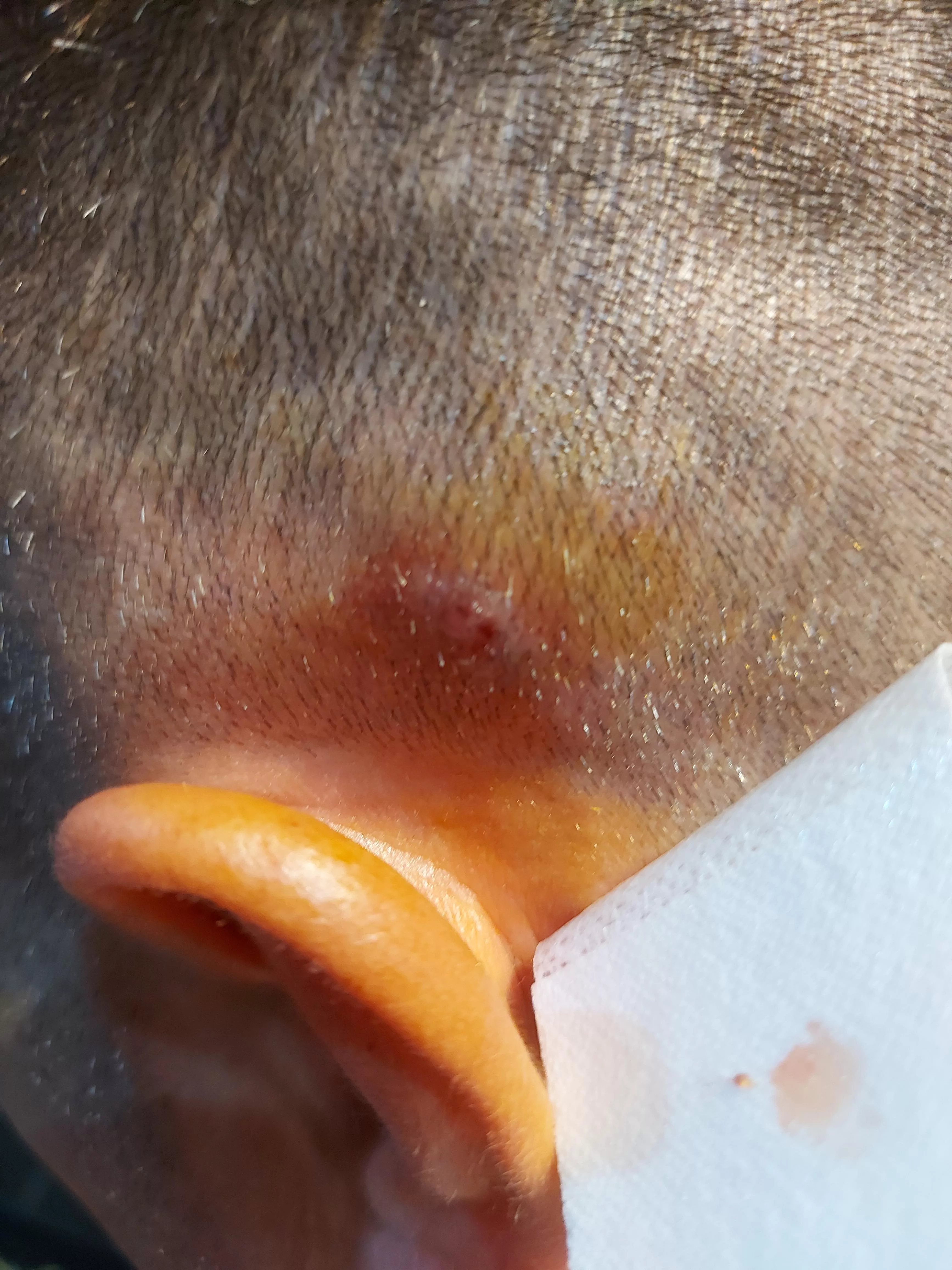 No idea what's that. Probably cyst or some kind of lipoma. Tried to squeeze it(with gloves ofc). But only blood and some brown pus came out. It's on my mother's boyfriend's side of head. He said that it just grew in a day. Cleaned with betadine and d posted by l1ttl3_81tch