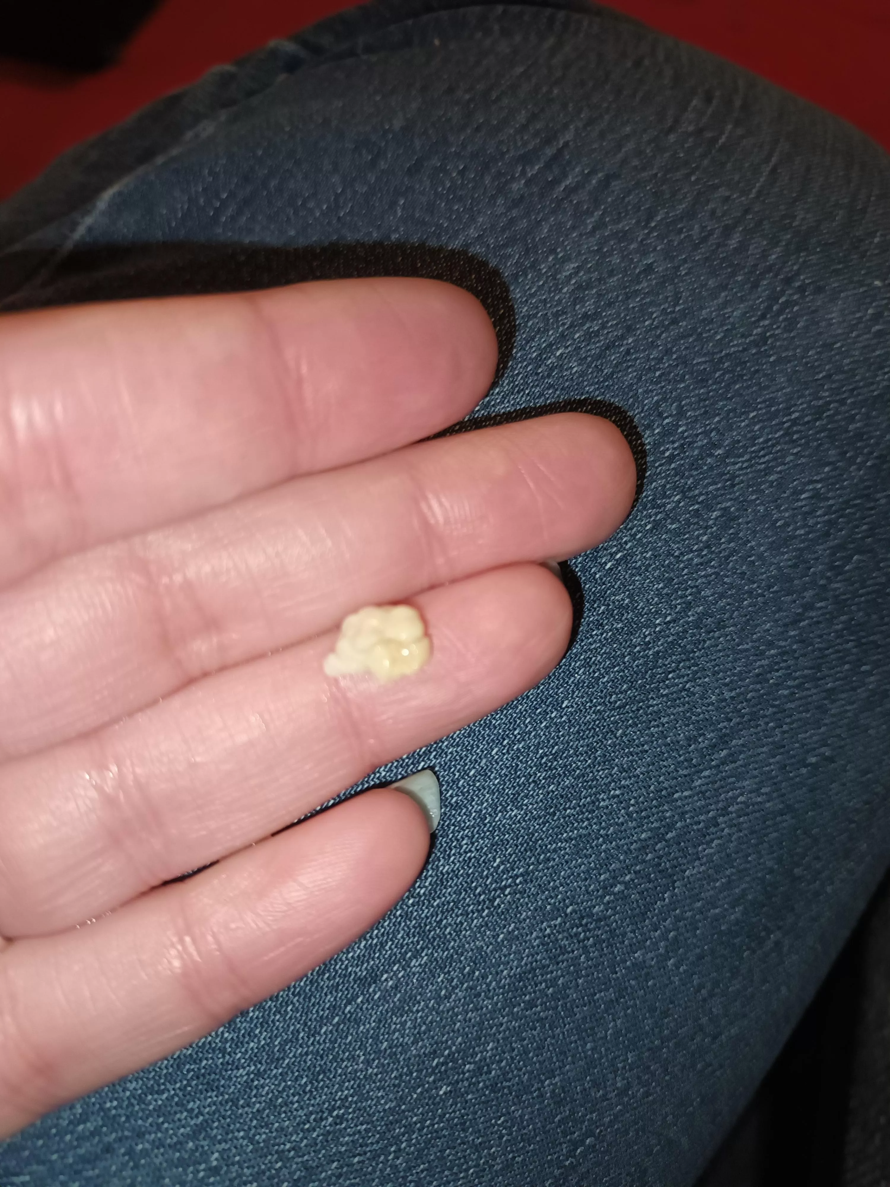 NSFW sorry no pop but just had this huge tonsil stone come out has anyone else had a big one took me by surprise. posted by somersetfairy