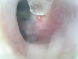 [OC] Forbidden pop- a whitehead on my eardrum?? How does that even happen?? posted by omeekajade