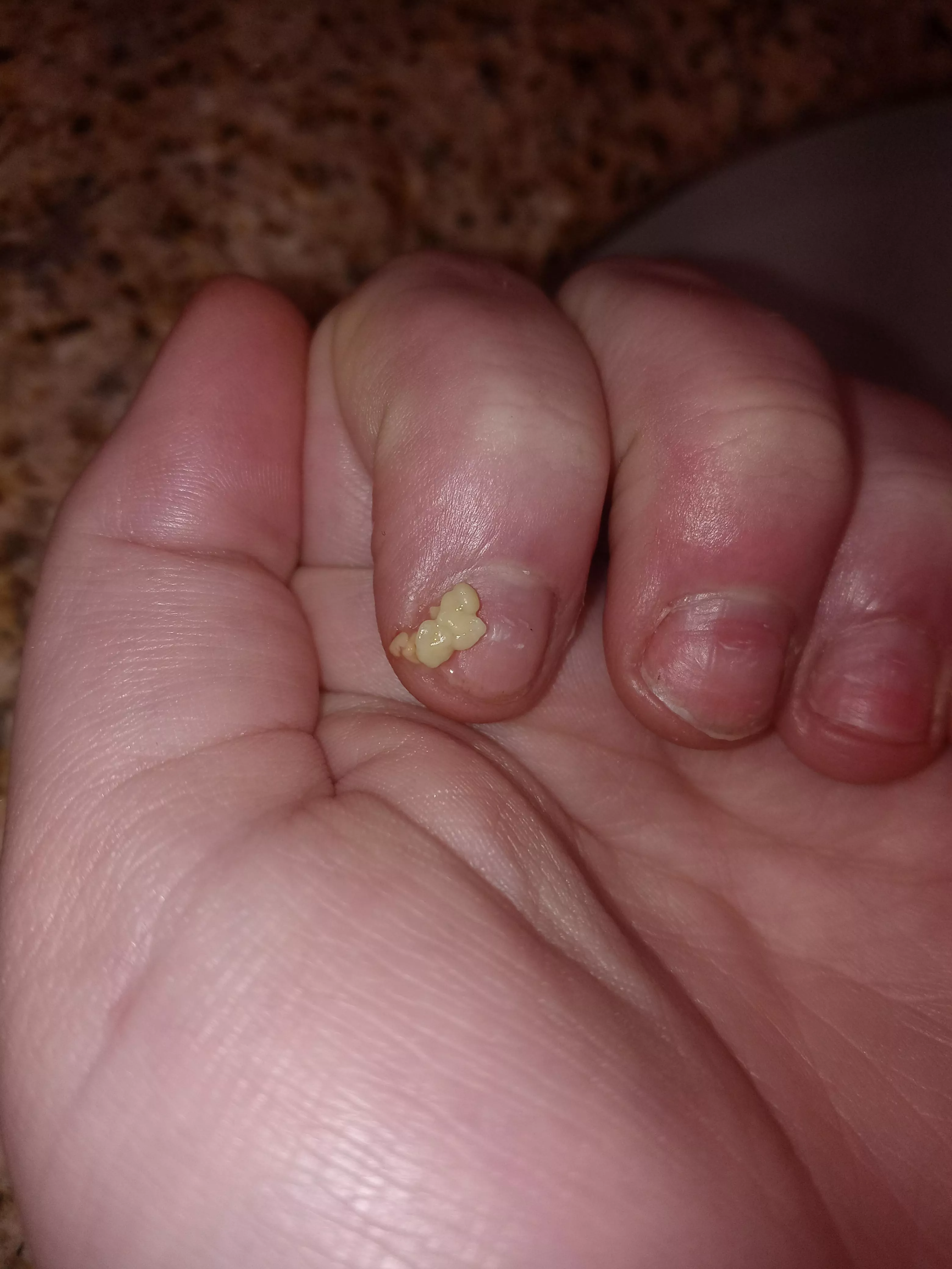 [oc] hadn't looked at my tonsils for a week or so and got these gems all at once (also just got acrylic nails off so don't mind my nails) posted by Slight-Comb-1708