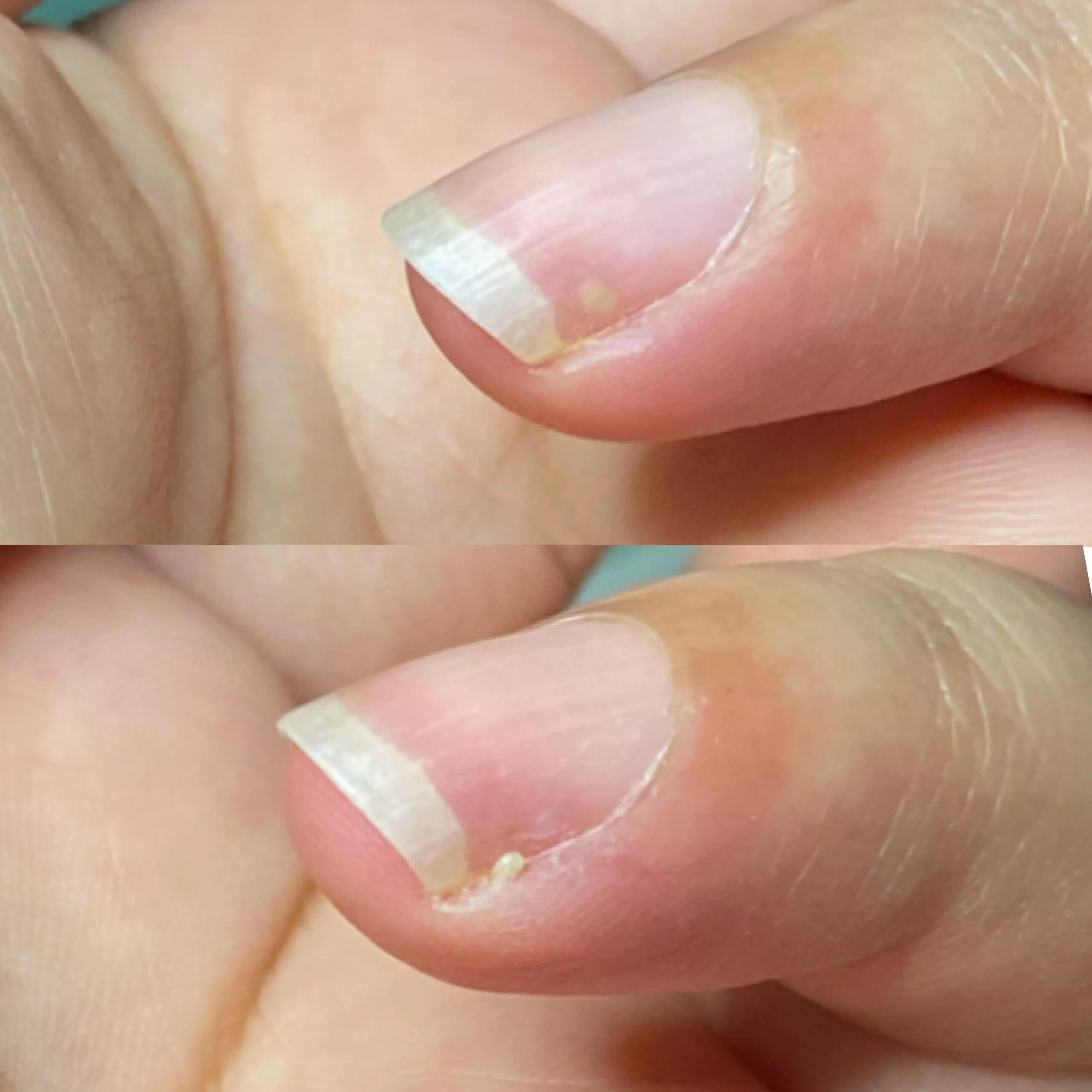 Omg - there was a pimple under my nail which i never thought would be a possibility.. i couldnt record it but took pictures posted by -Kae