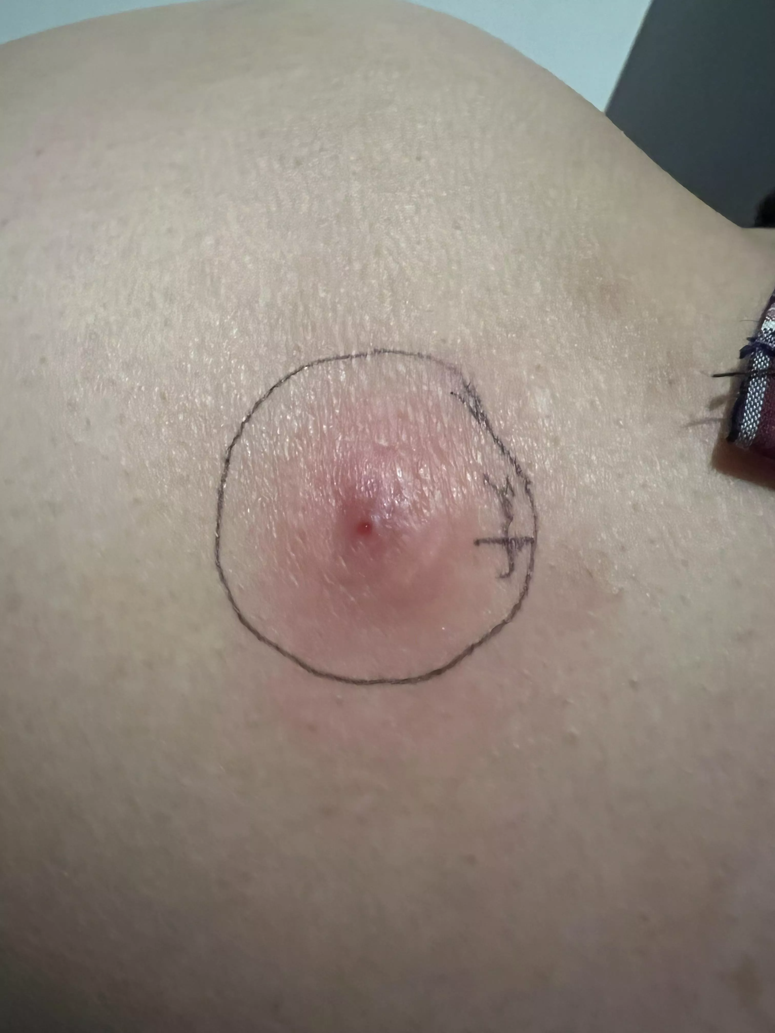 On my husbands hip, waiting to see how it goes posted by geepr