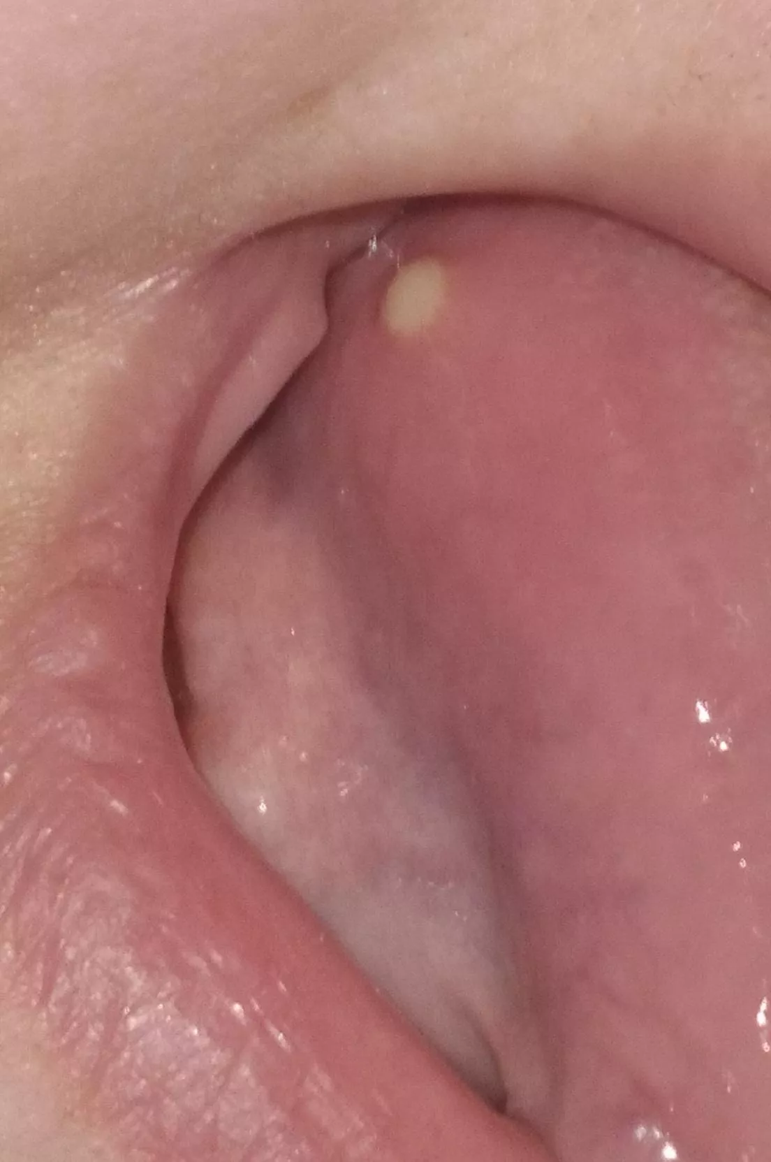 On the tongue, finally popped on its own but ewwww posted by Over_Discipline_8363