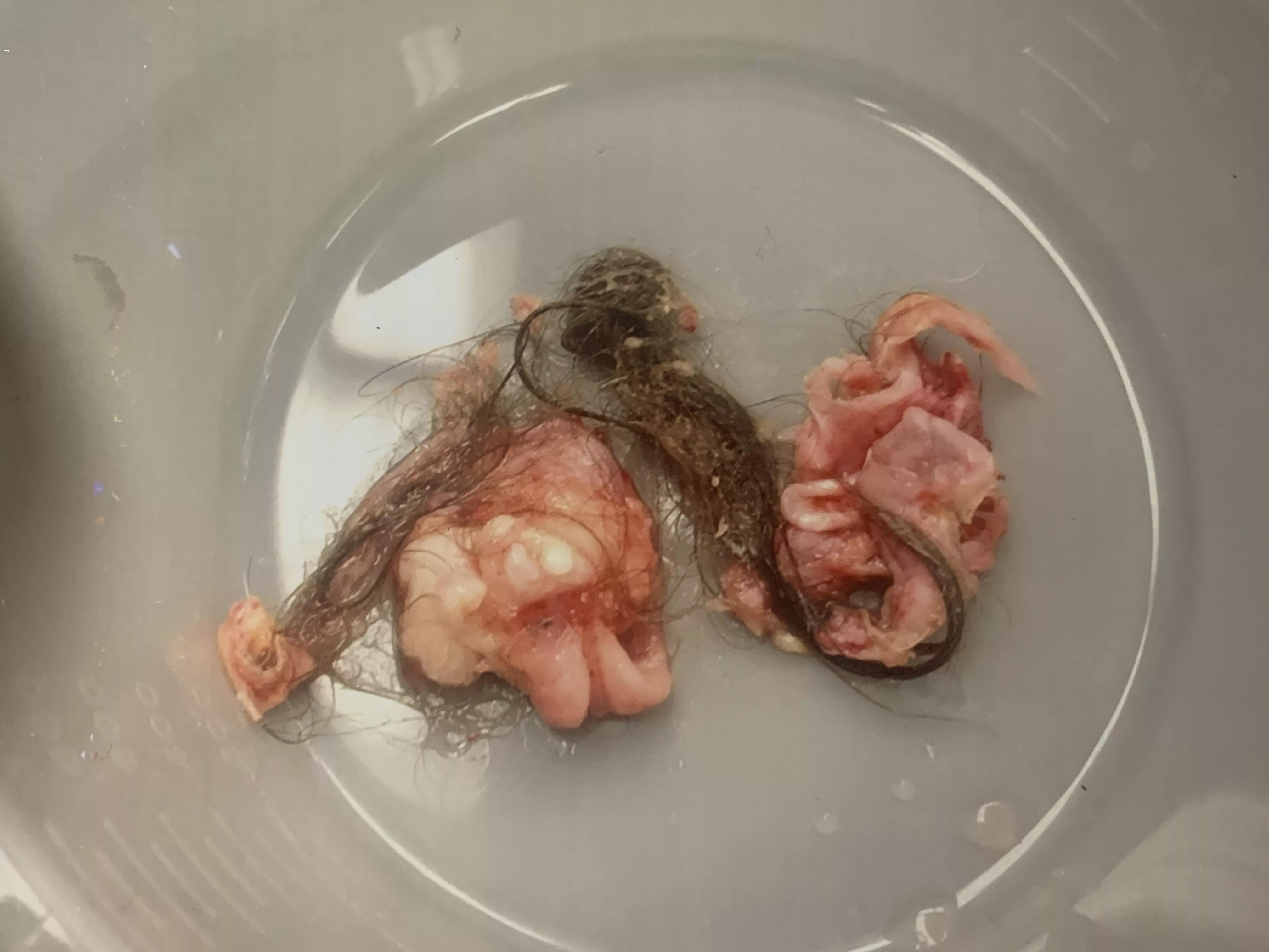 Ovarian Dermoid Cyst: complete with hair and even a tooth. 5cm posted by tooty_mctooterson