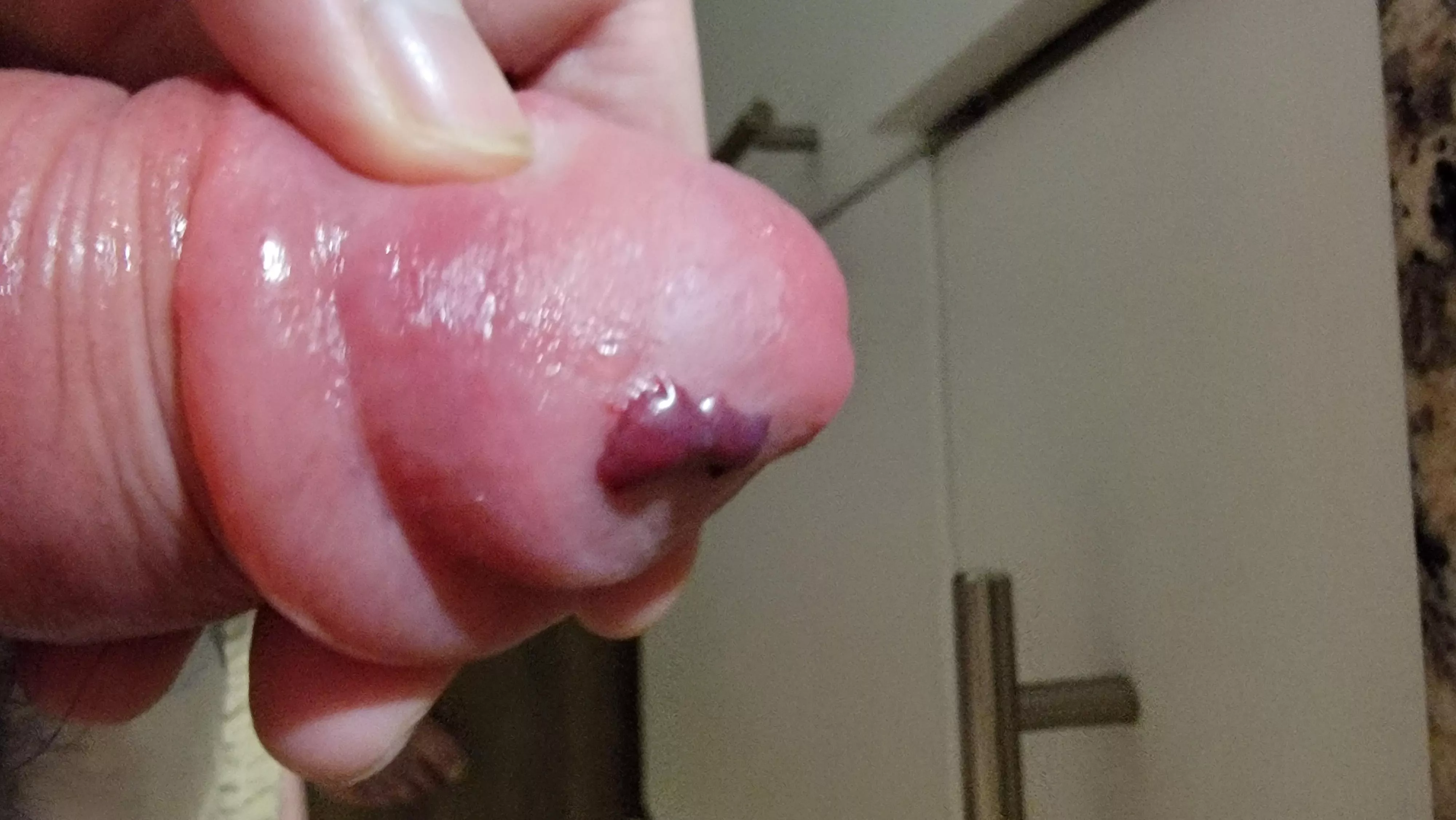 Over pumped! Should I go to the ER? Blister and swollen gland.... posted by JustARejectedDude