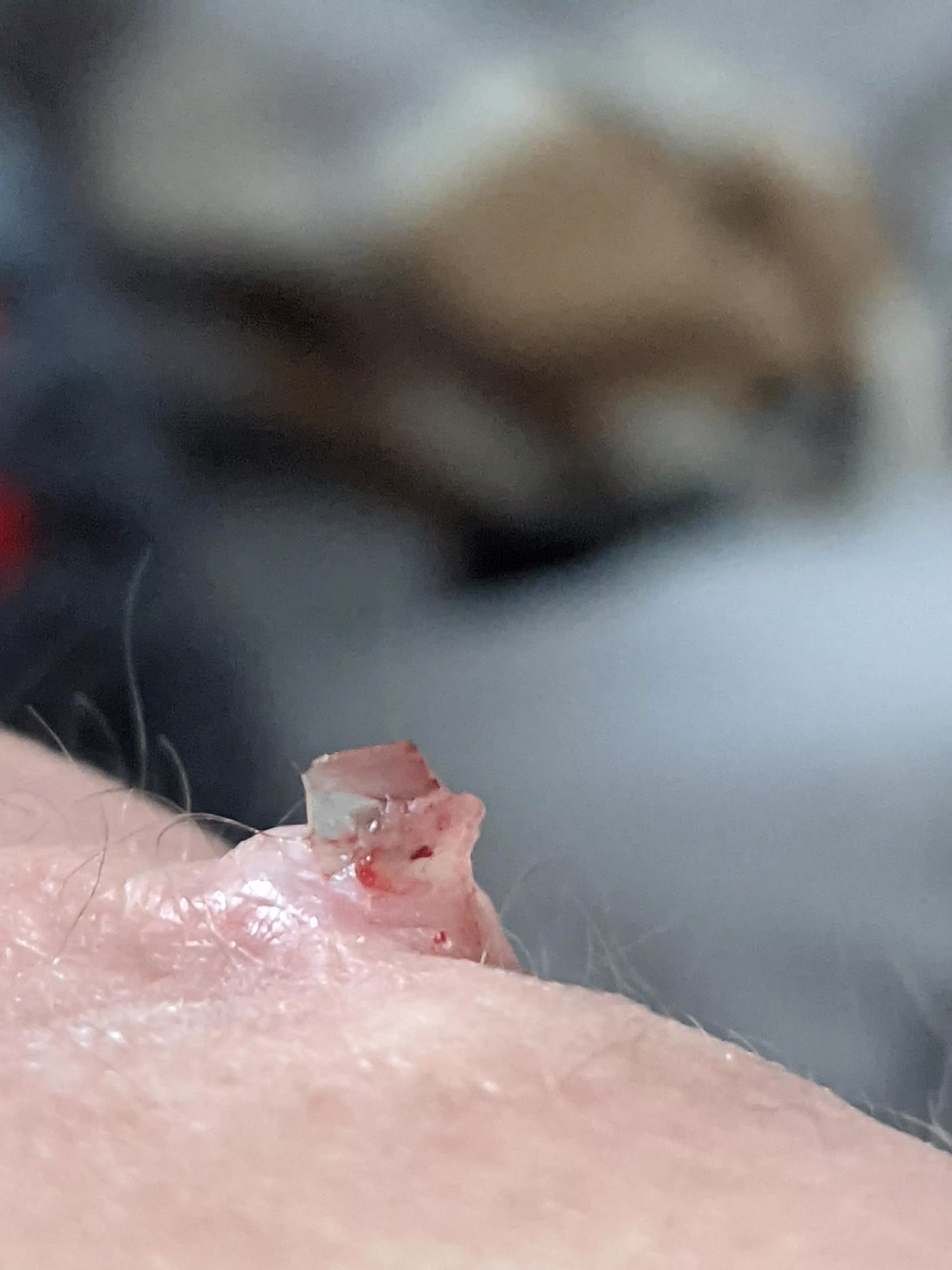 Piece of glass finally came out of my elbow after my accident in 2017 posted by RyanHayabusa