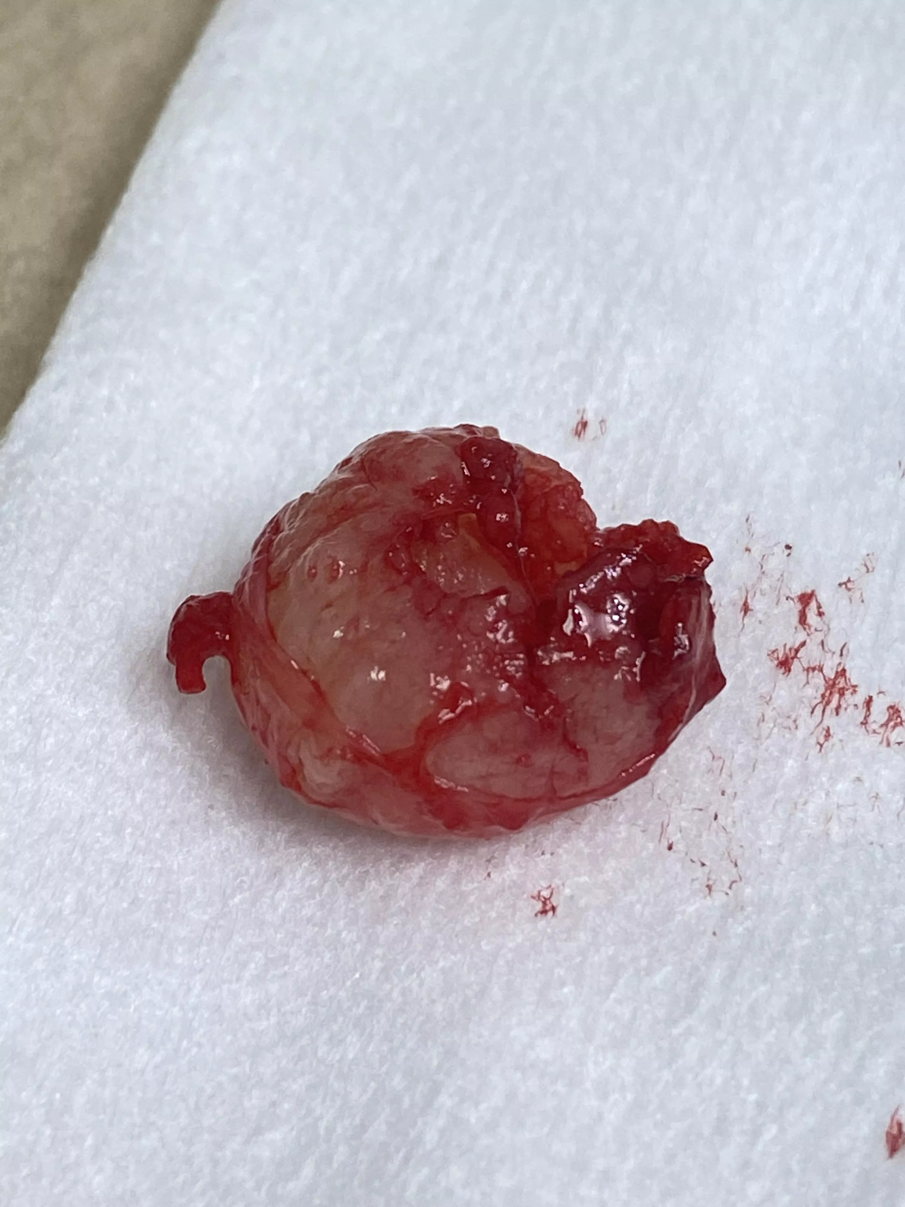 Pilar cyst removed from husband’s scalp today posted by xenophonica