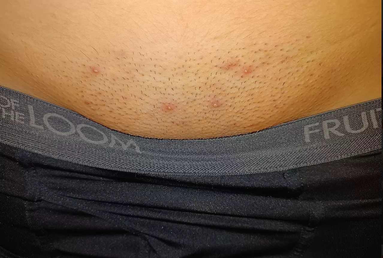 Plucked some ingrown hair and they came back pissed posted by Deconstructed-yumyum