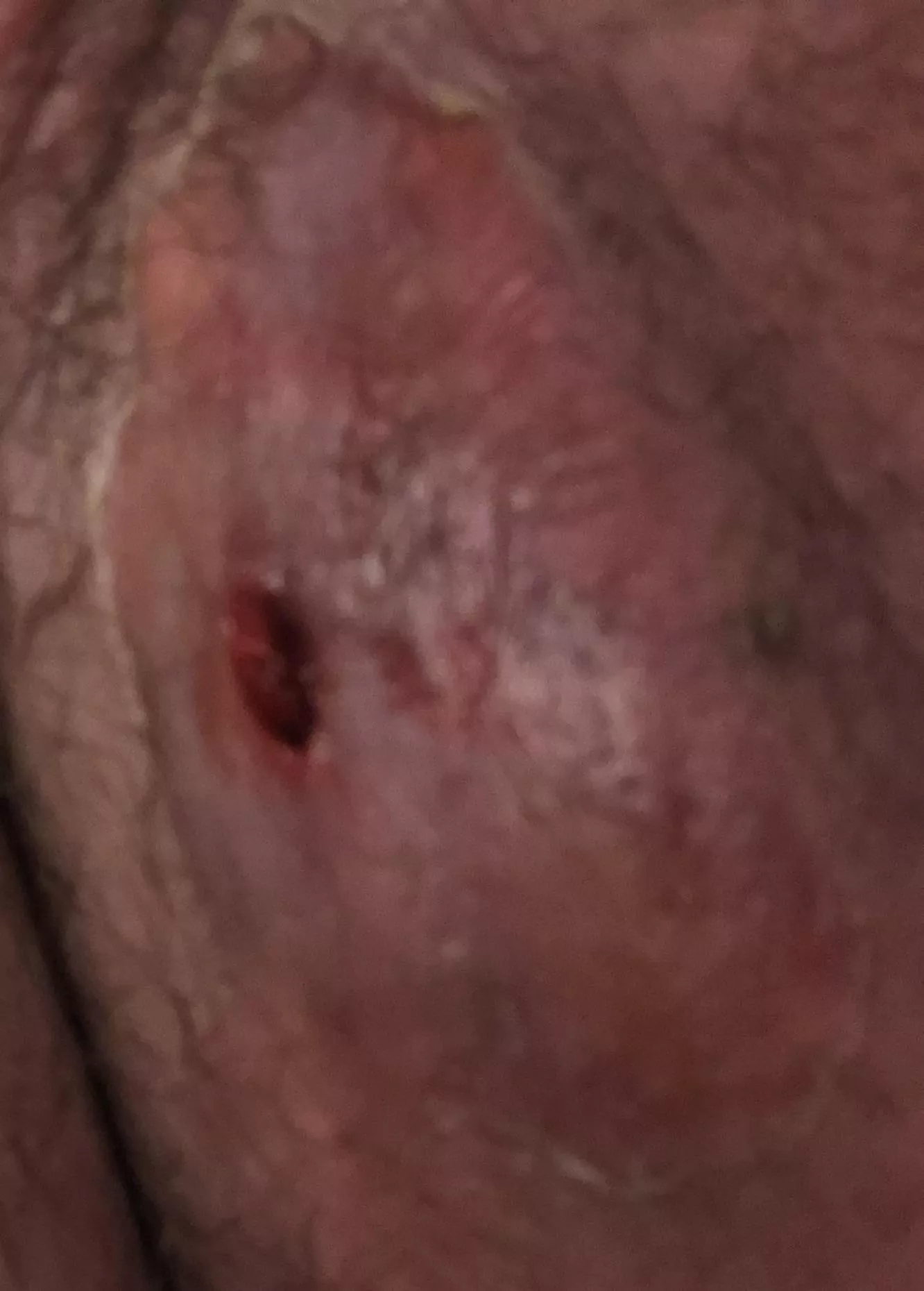 Possibly my final update. Unfortunately I never got to film it and all that’s left is a bloody hole. Now I’m just looking for ways to make sure it doesn’t get infected while healing posted by PoeticTinkerer