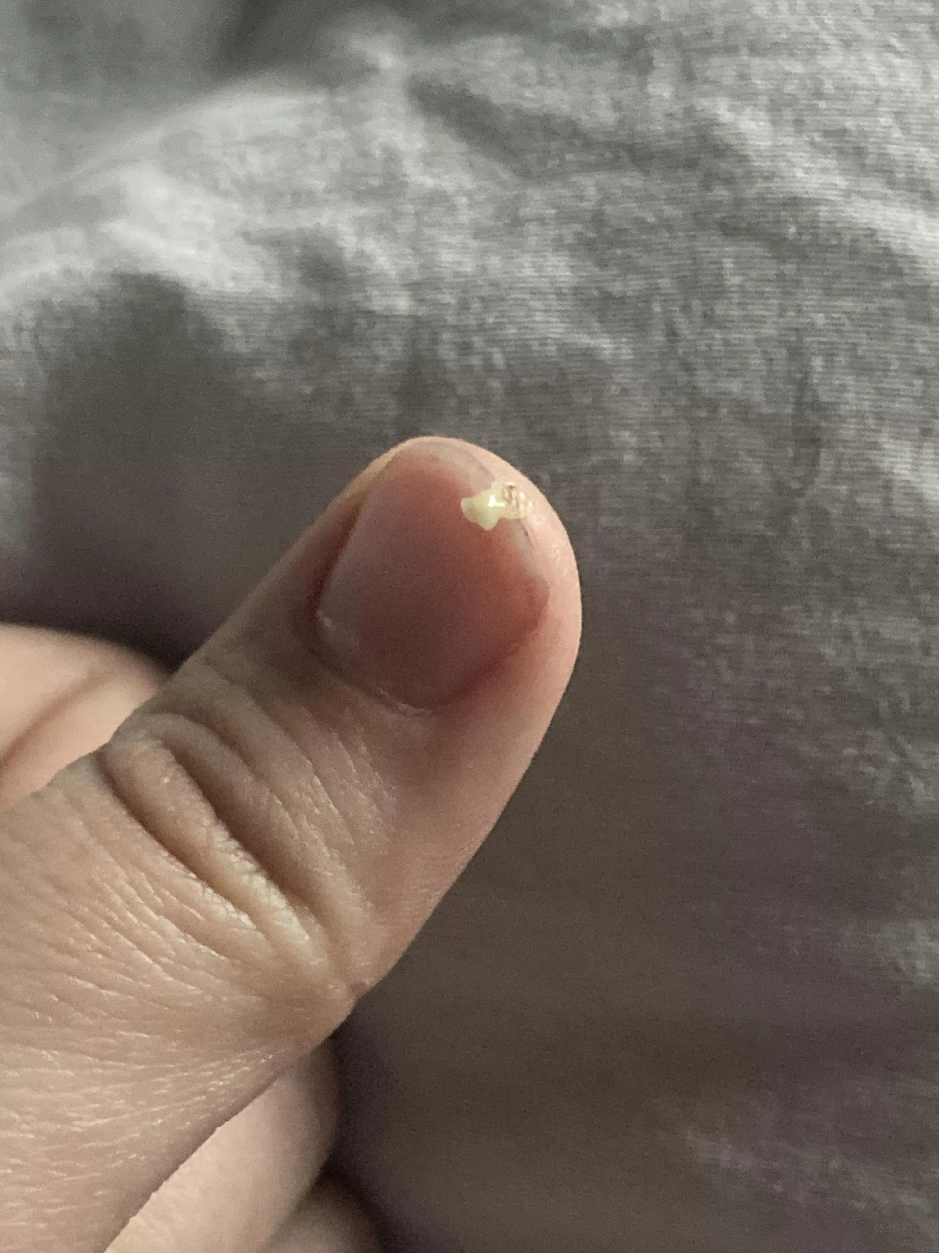 Pulled this new friend out of my nose a few minutes ago (A cyst according to my sister, though we may be wrong) posted by hailgoatsimulator