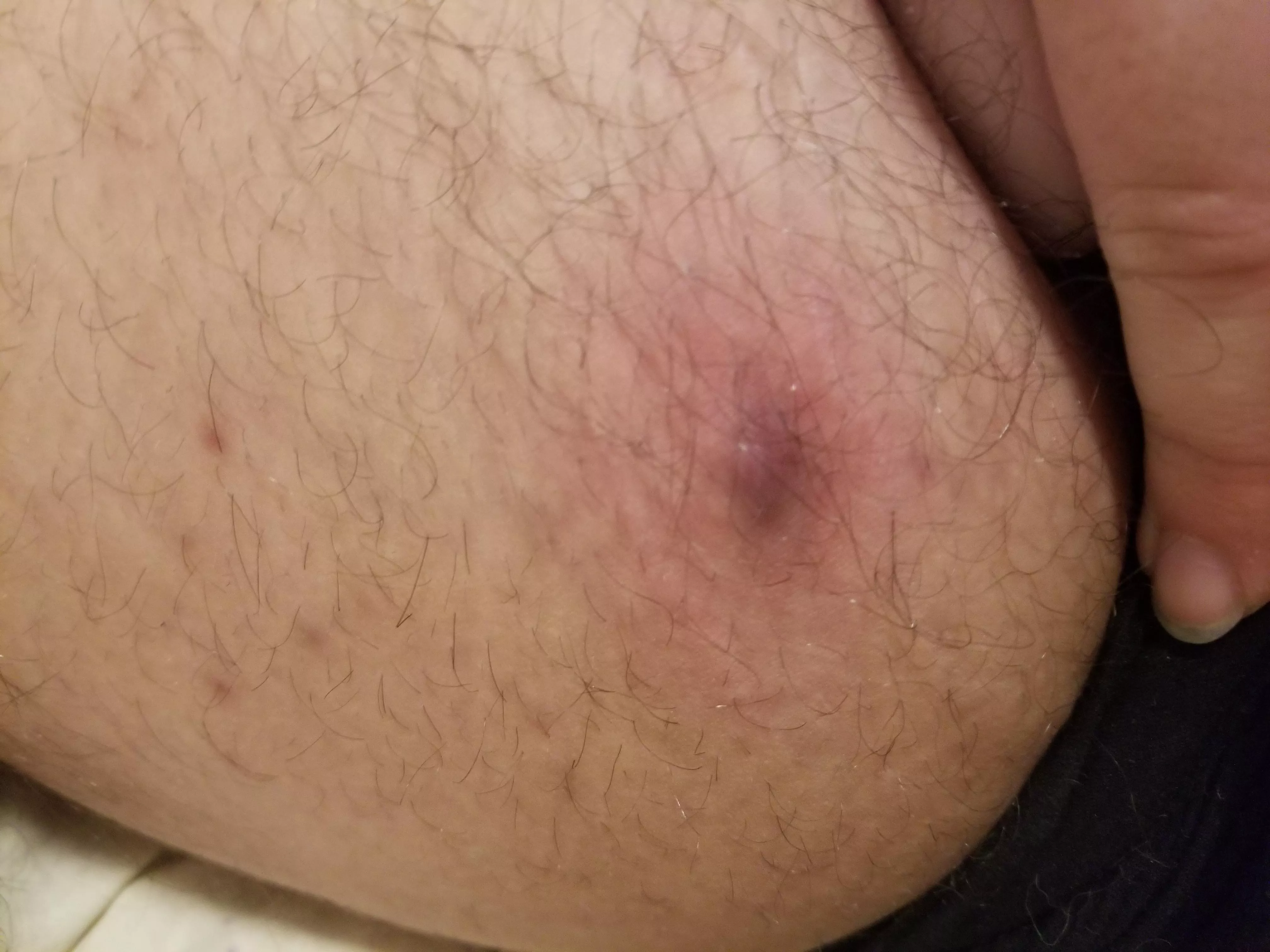 Really want to pop it but probs shouldn't. Doesn't hurt much at least posted by recovering_depresso