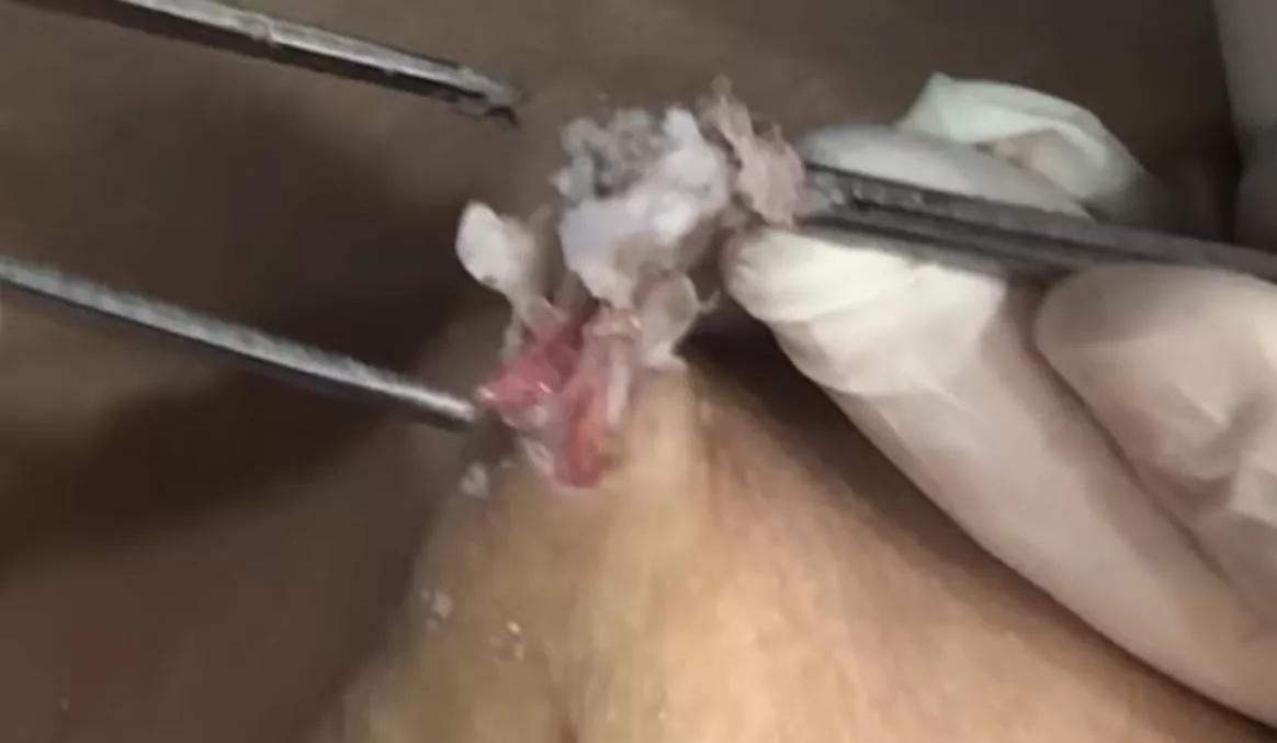 Savage attempted removal of epidermal cysts WARNING It’s unbelievably frustrating & had very scary use of rat tooth tweezers! Link in comments. posted by Hunni_Bee