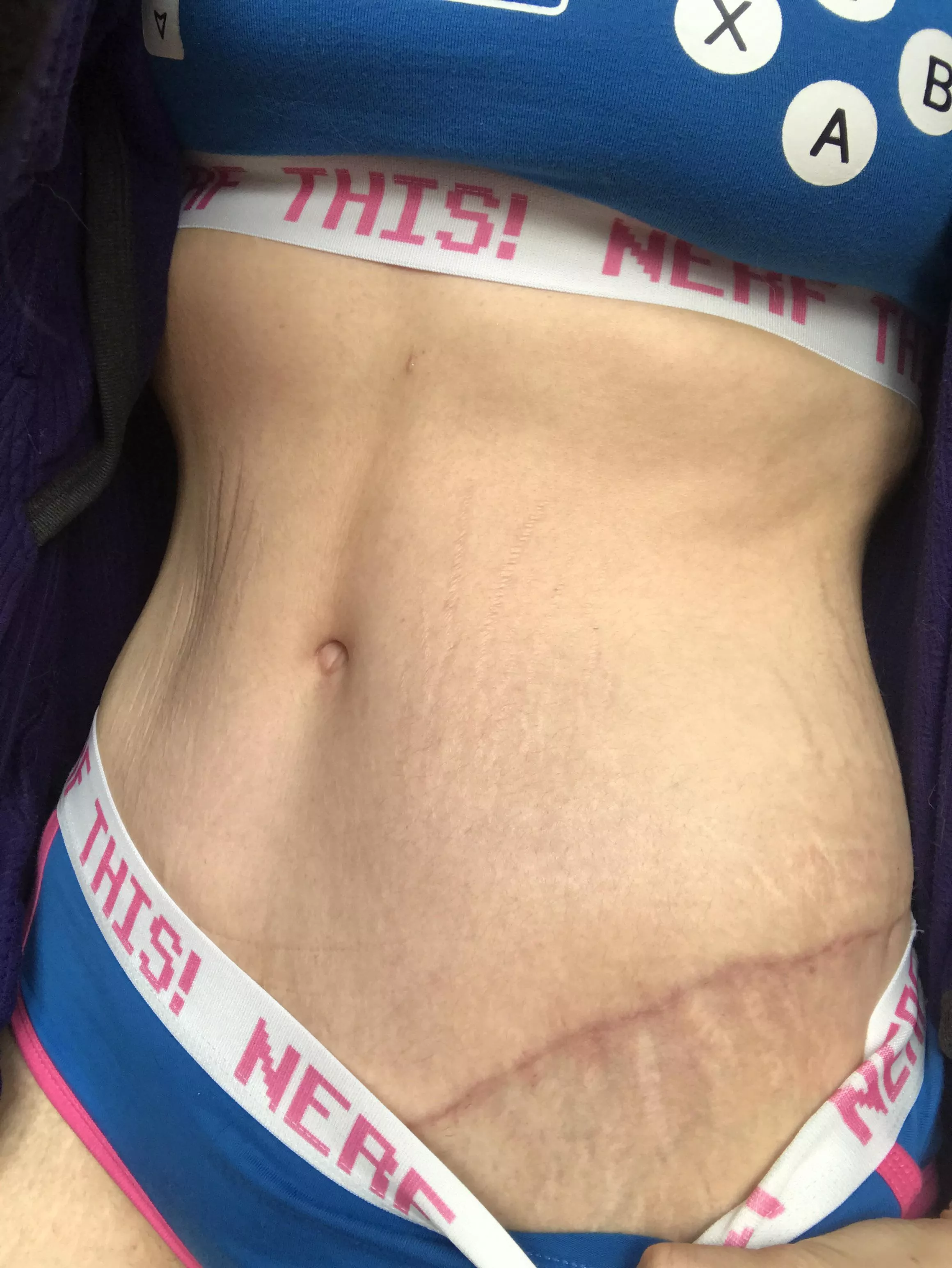 Scars or stretch mark fetish? posted by HotBottle9836