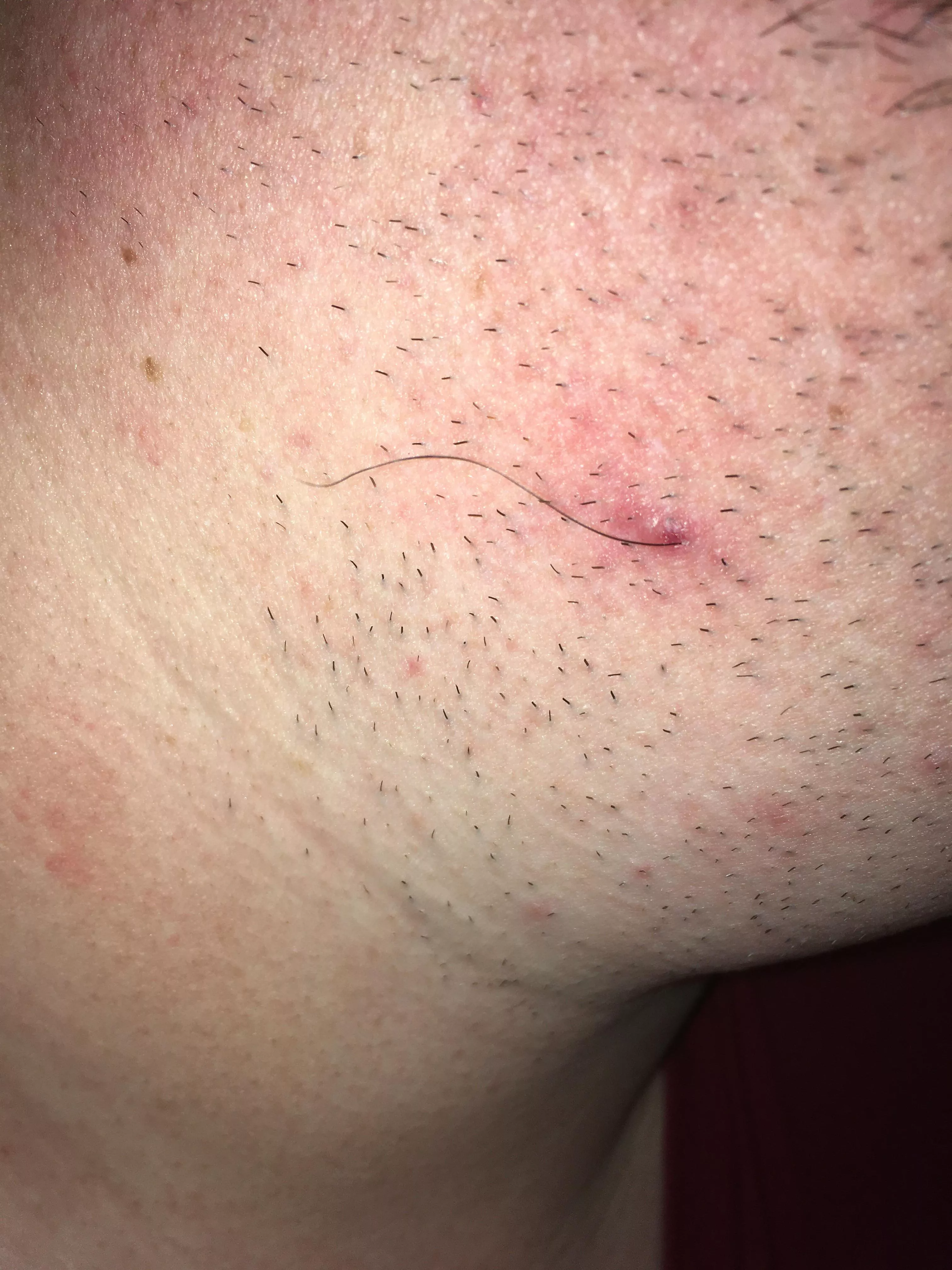 Scratched what I thought was some dead skin from an old bump on my neck. This hair came with it. posted by red_byrd