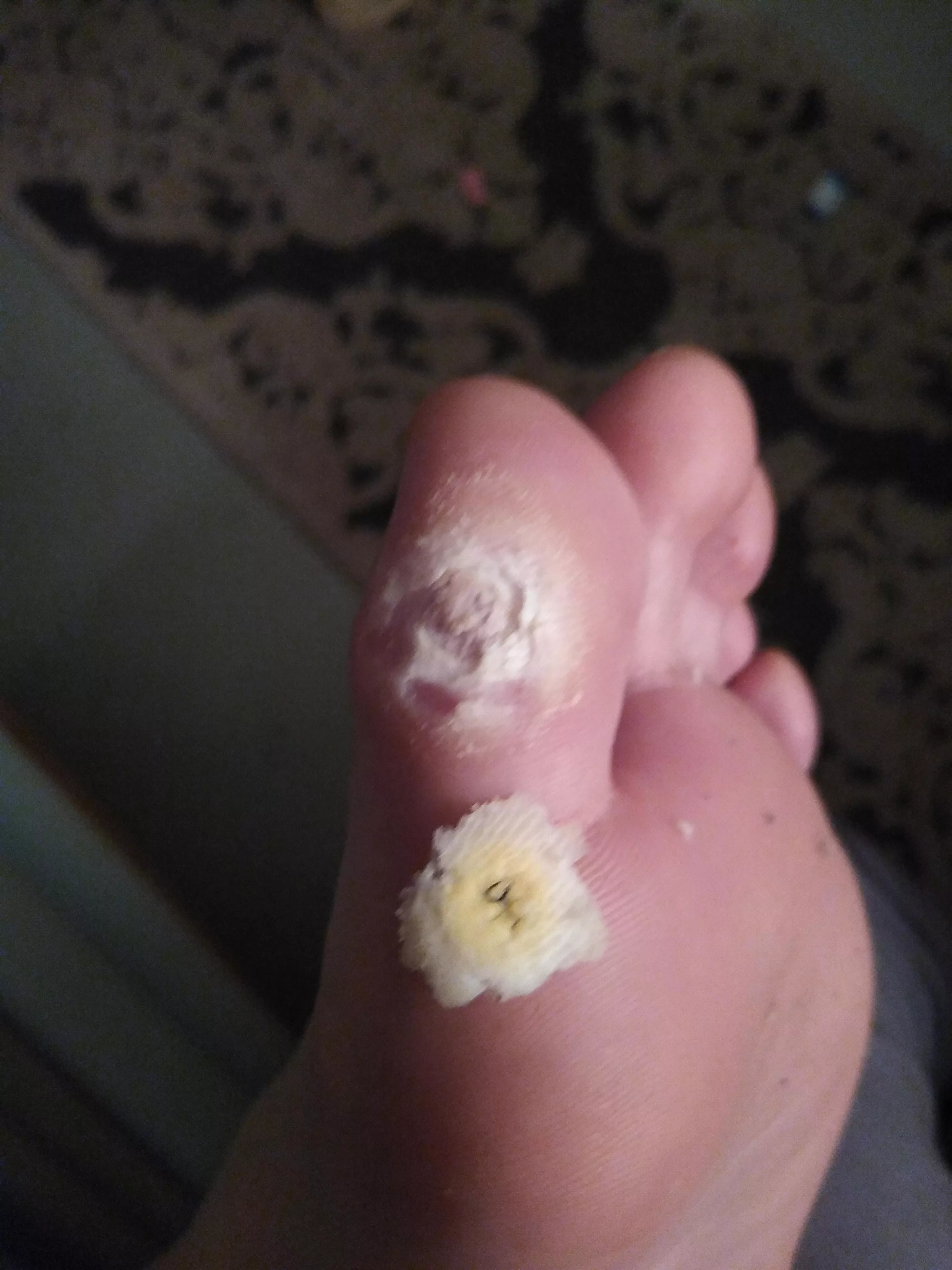 Second time trying to remove a corn on my big toe. Used salicylic acid patches for a week. posted by Dangerous-Bat-8698