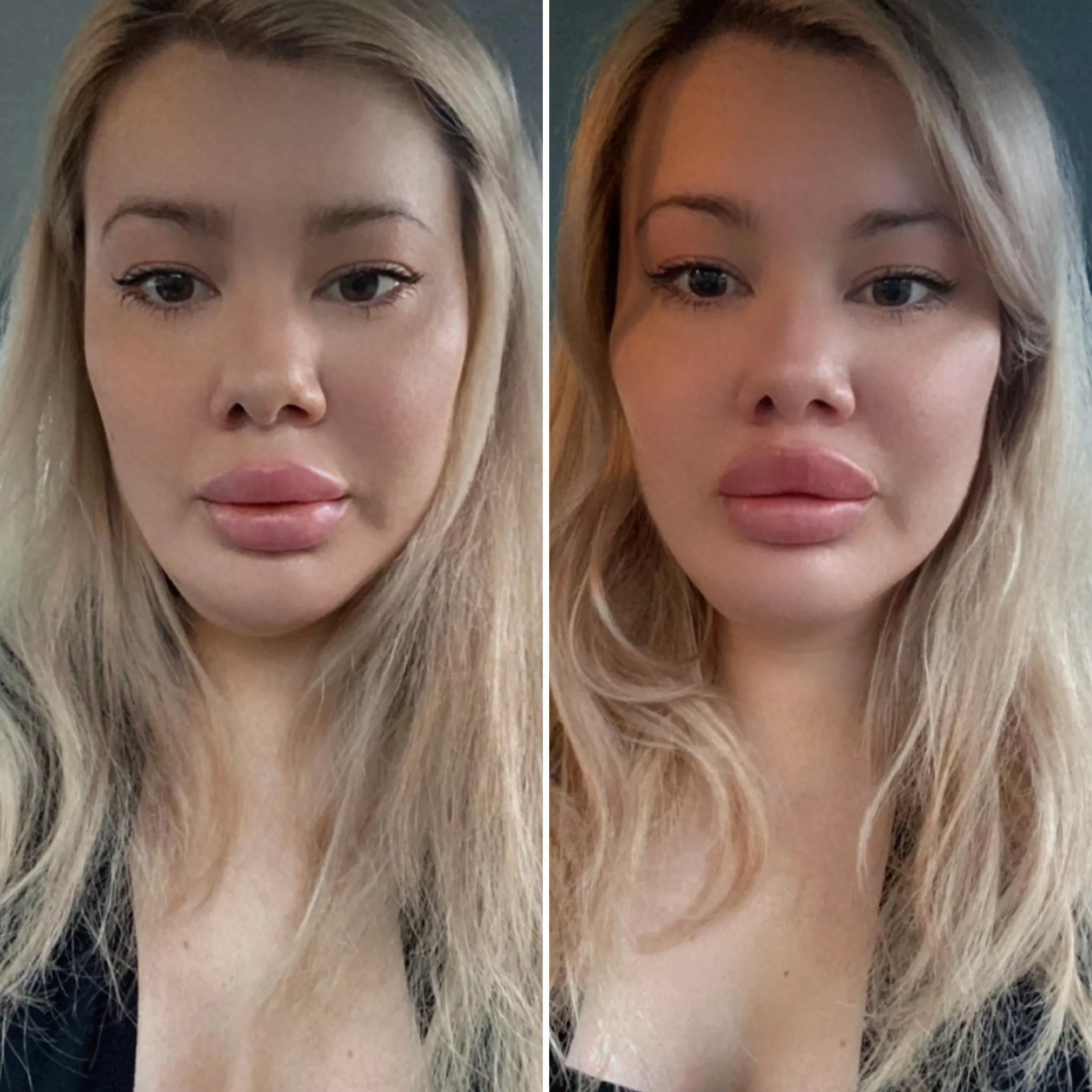 So excited by my new lips, cheek filler and Botox. I dribble without a straw and can’t wait for my frozen face to set in in the next day or so. 💉👄 posted by Itsdollymix