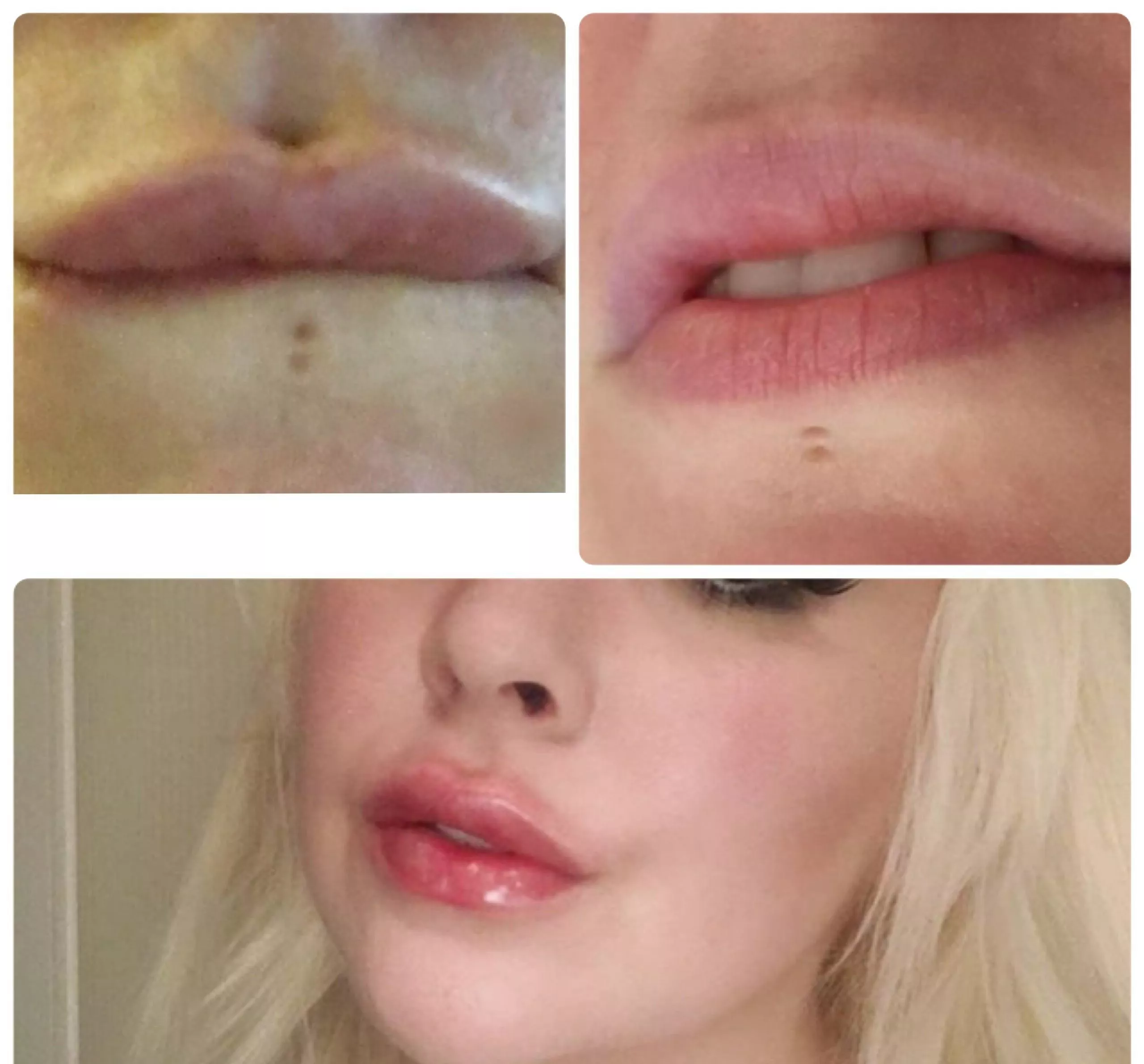 Some ilp filler progress, npte how I never had a Cupids Bow but skilled filling of the border has given me one! Pumping them up more on July 29th, now I have the shape its time go to go crazy with volume. Making good progress with my savings for a BA too posted by lingeriebudget