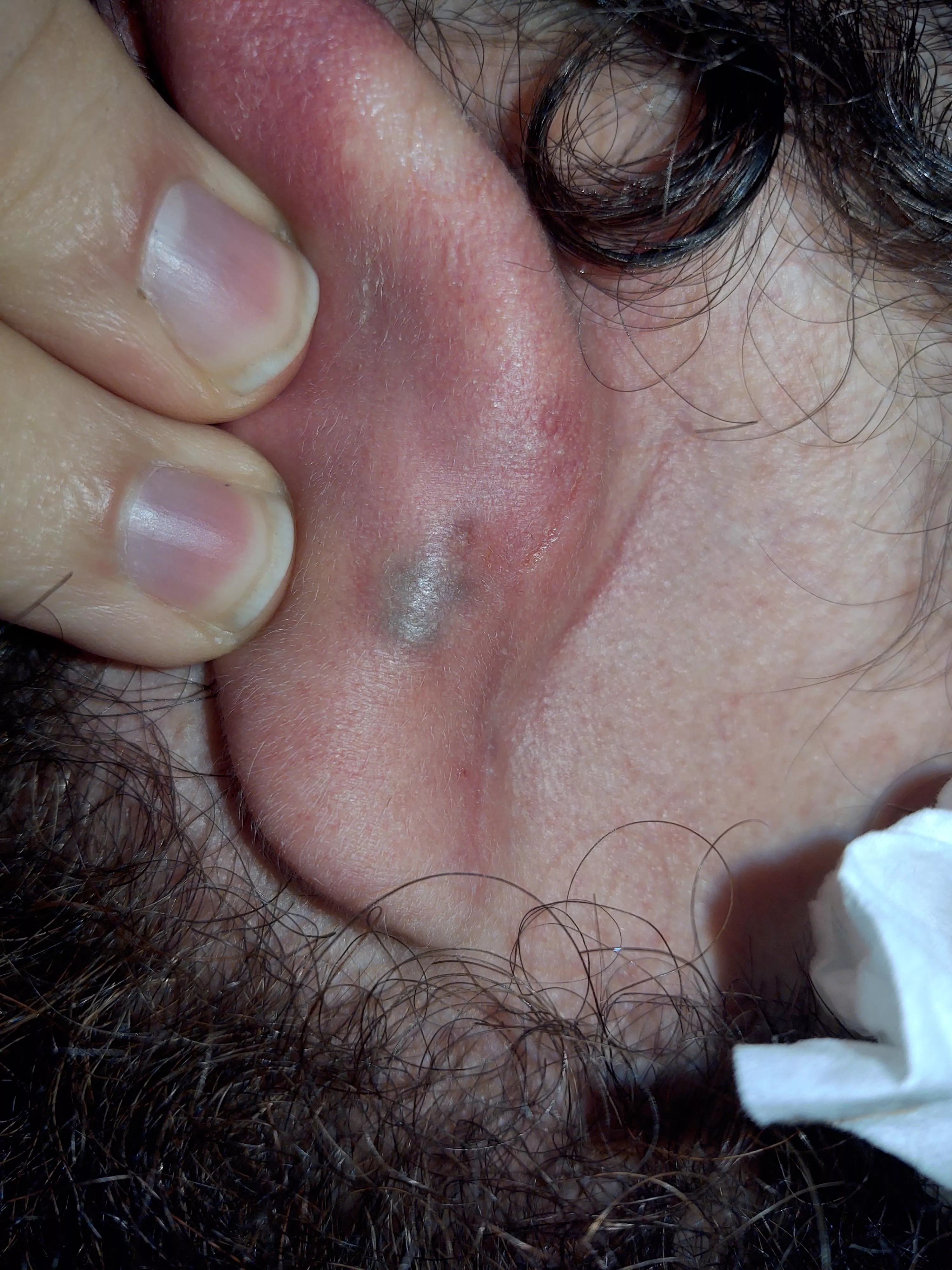 Spouse has a weird blood blister behind ear. Not sure if we should leave it alone or attempt to pop it? He has had it for a few weeks posted by BexiRani