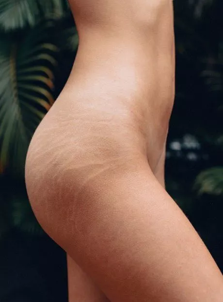 Stretch marks posted by Fancy_Revenue2682