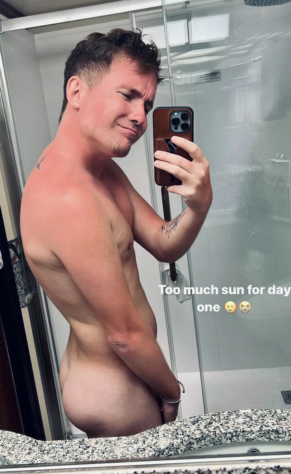 Sunburn posted by Jayyckk