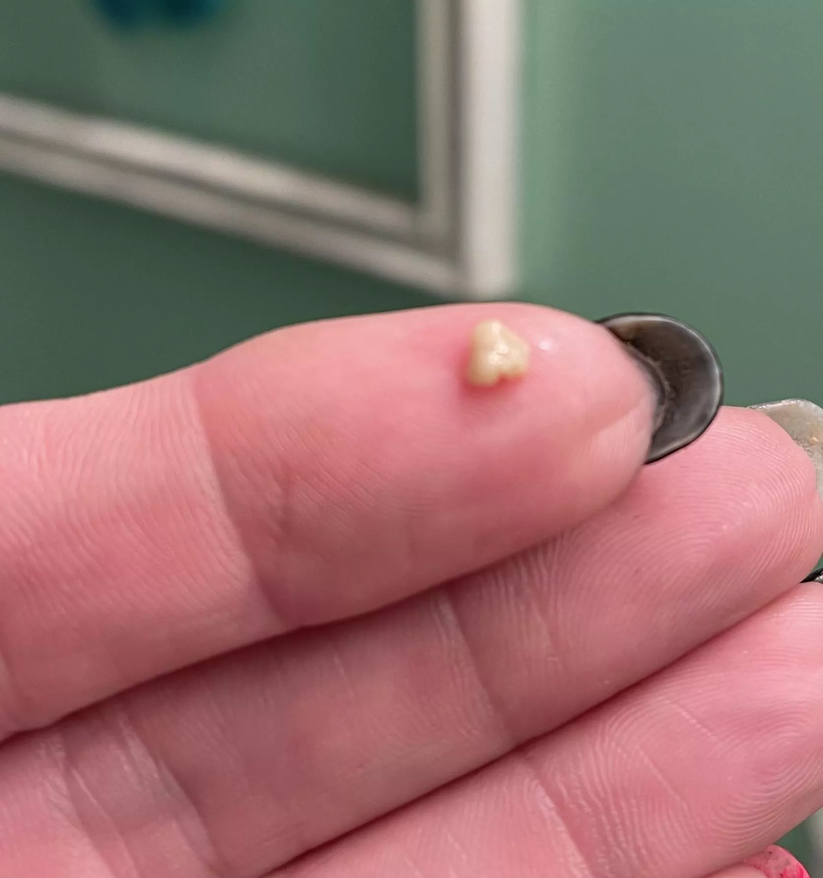 Surprise tonsil stone - only ever had one other before in my life. posted by skeletor_grl