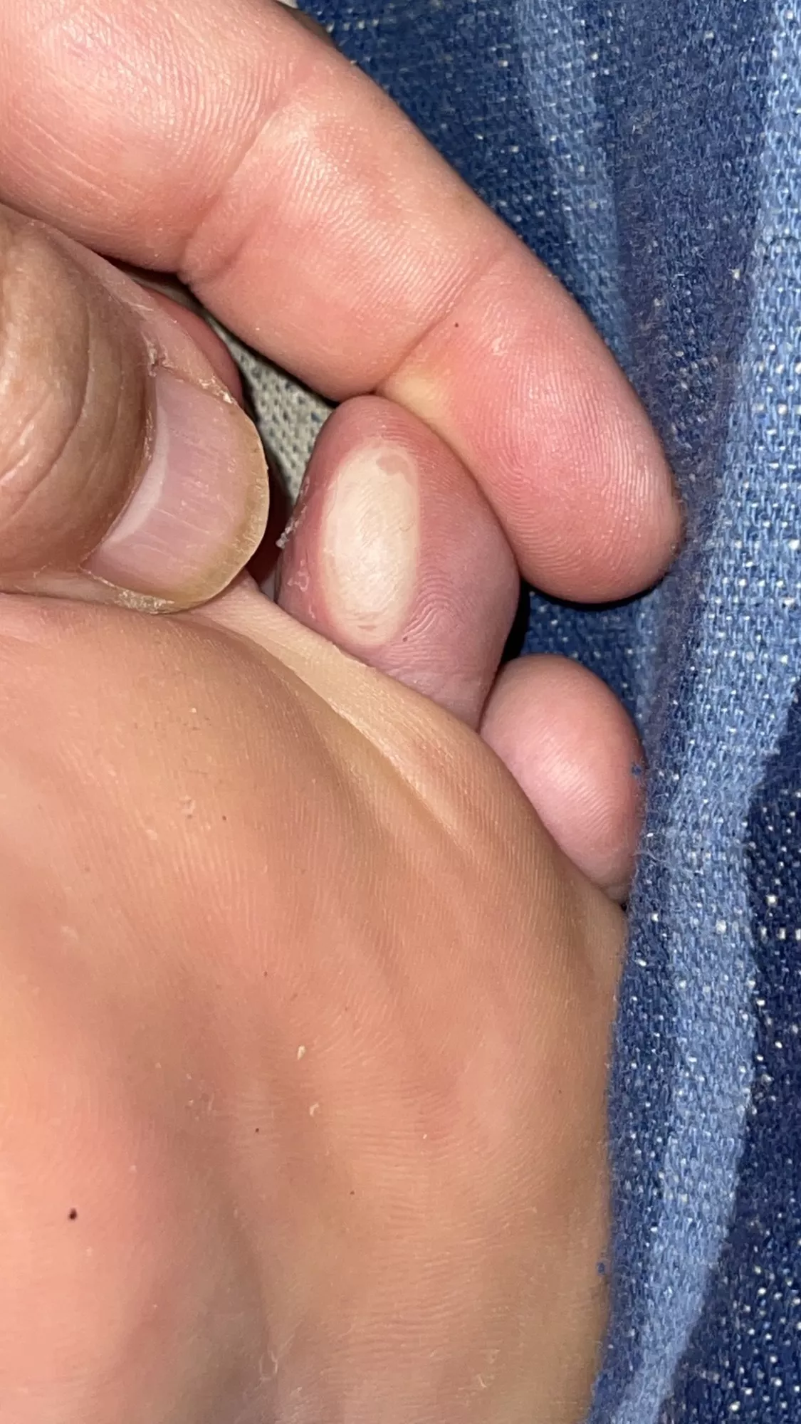 Thank you Disney World for this three day walking blister. i’m surprised it never popped. posted by Tandom