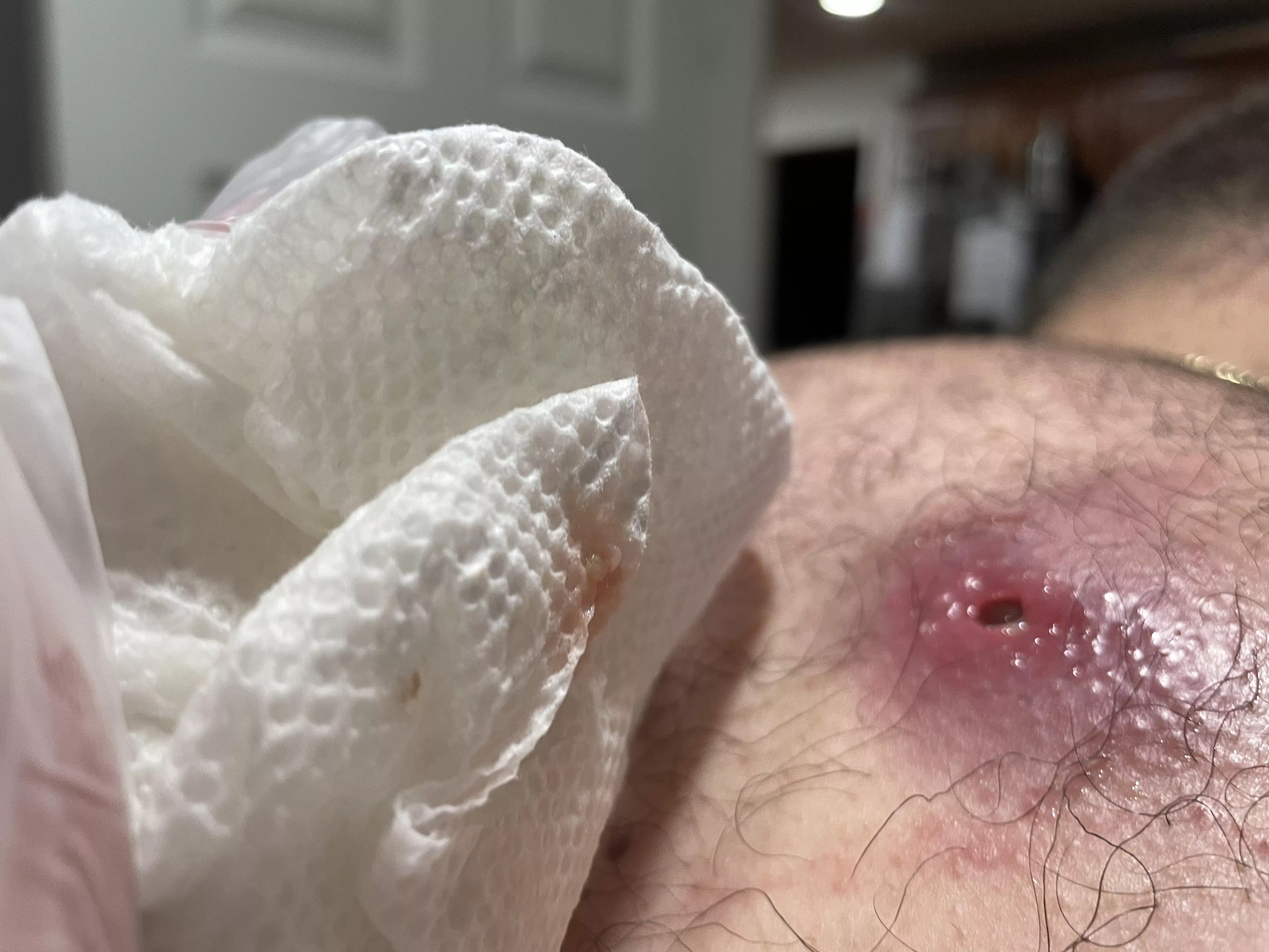 The aftermath of a cyst draining posted by chief1988