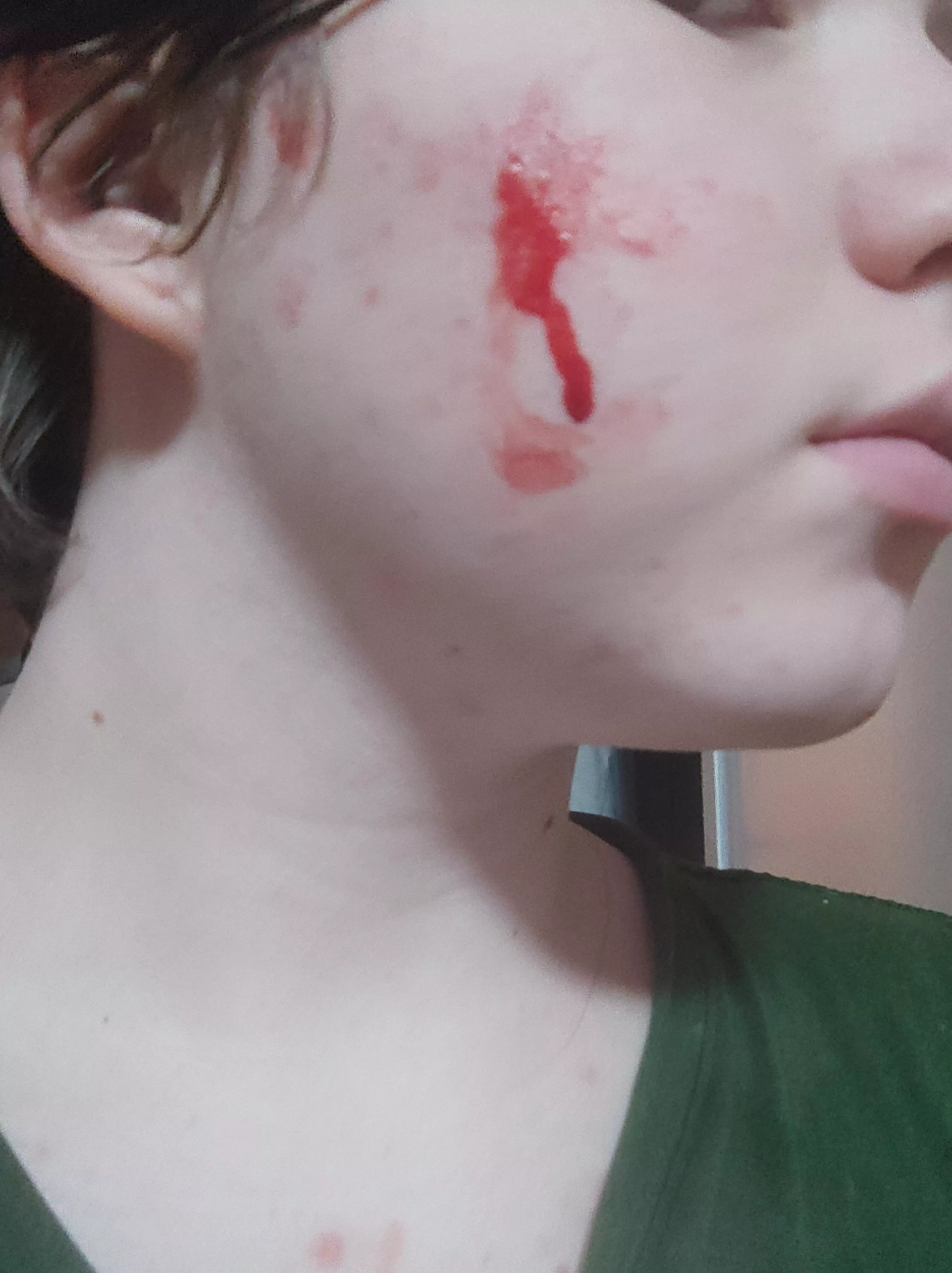 The aftermath of me trying to get 3 pimples (stacked above each other) out of my face. Been there for at least 2 weeks and it's annoying me and hurts when I touch it. Now it's even worse posted by Cherry_Kakyoin_69