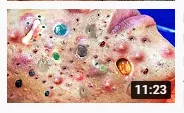 These thumbnails are getting out of control! Not gonna lie, I'd watch the heck out of colorful pimple pops! posted by psychnursegivesshots