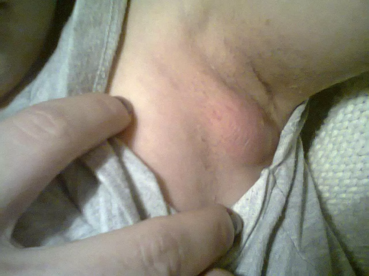 This is my armpit before surgery. Do you want to see how it looks now? posted by b_queen_b