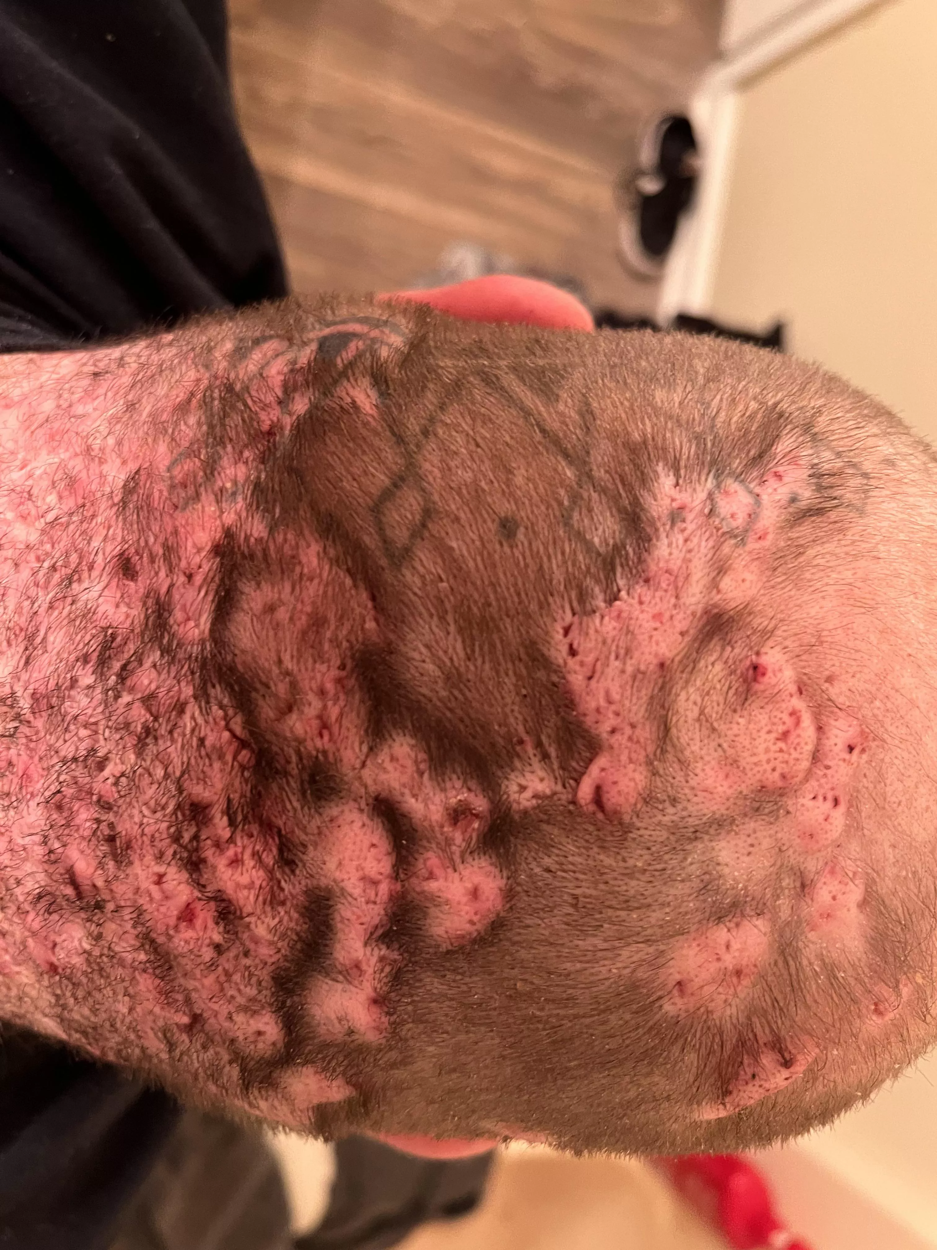 This is the back of my neck. No pops just bumps. posted by harrysguns