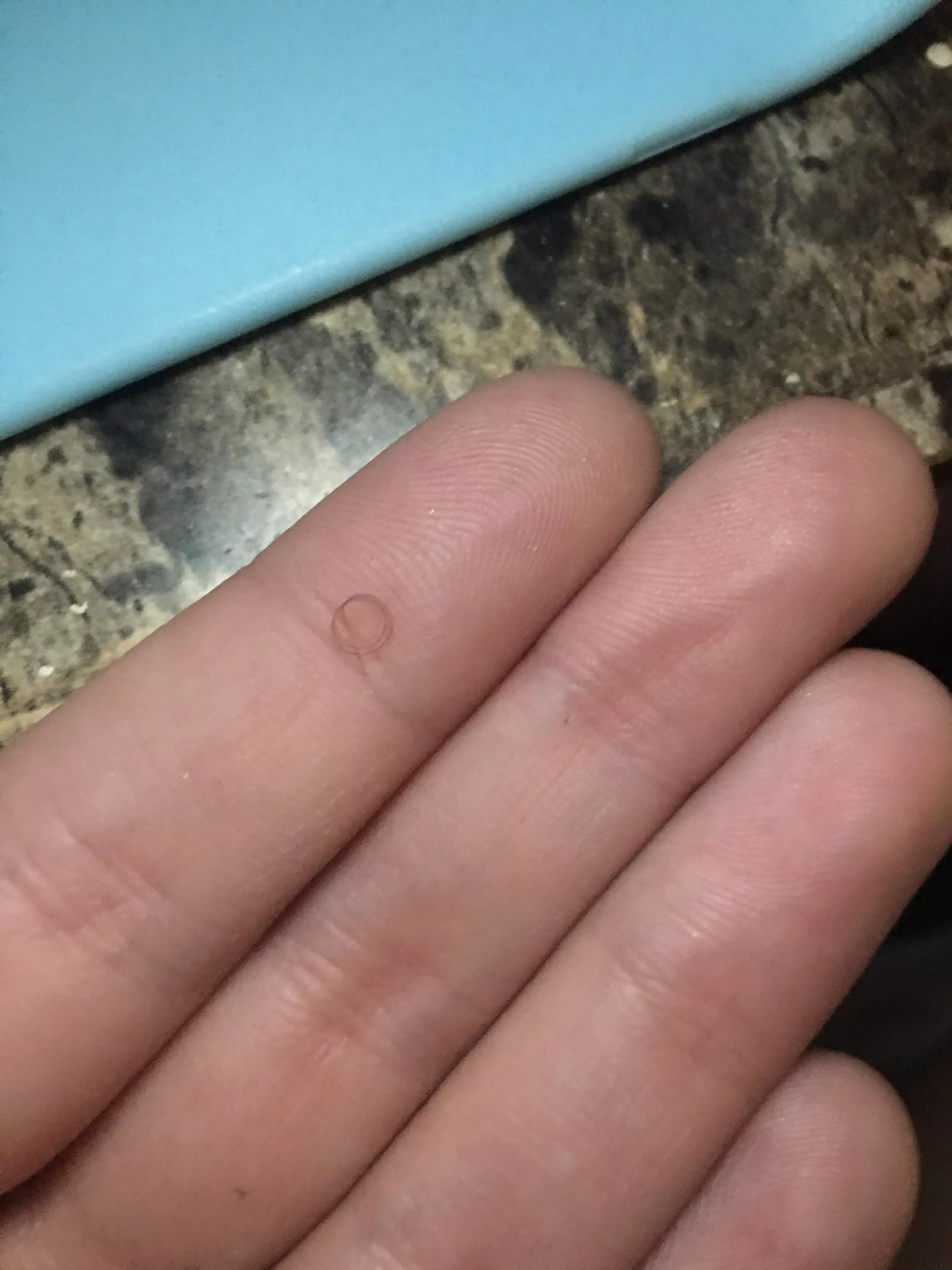 This was the ingrown hair from my pubic area. I got it out after. OC. Cont. posted by Routine-Key2175